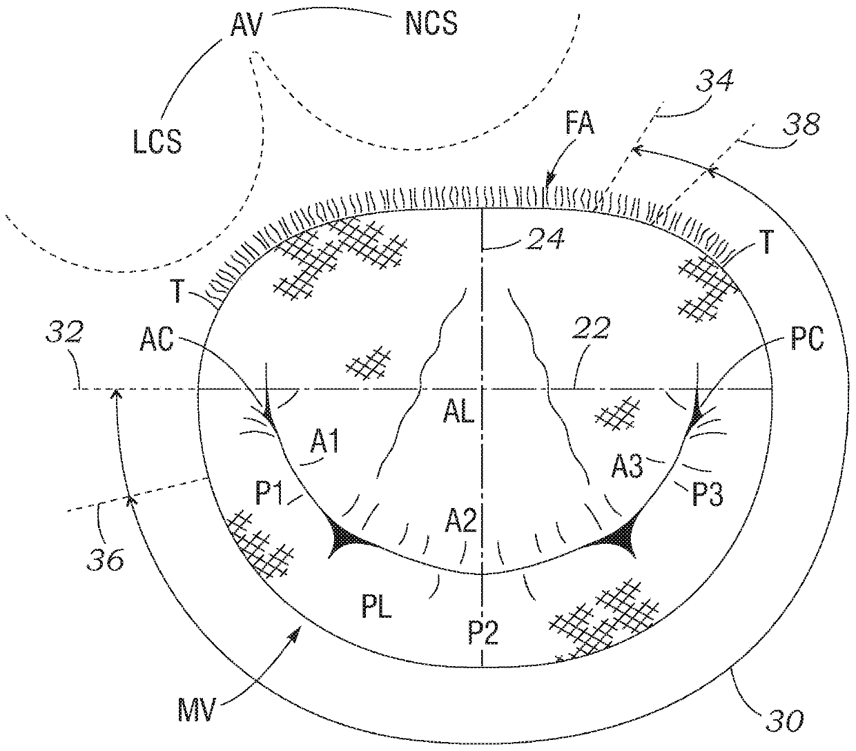 Asymmetric mitral annuloplasty band