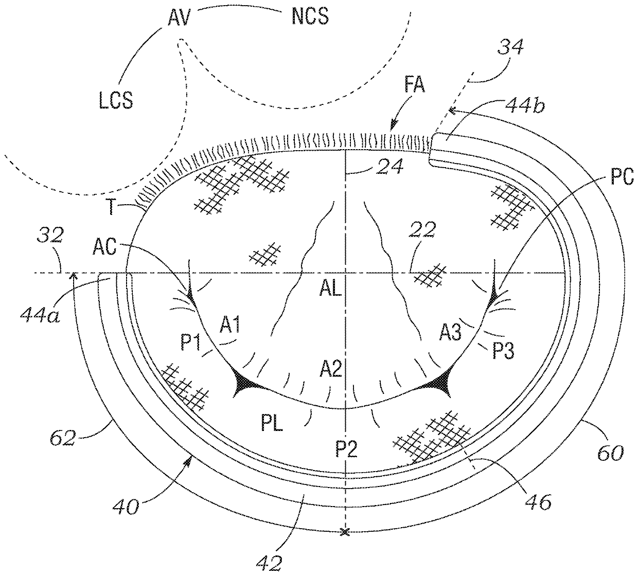 Asymmetric mitral annuloplasty band