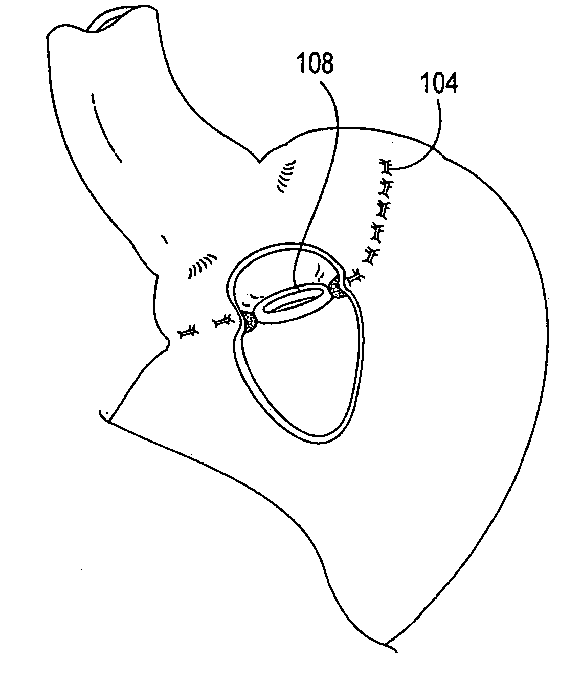 Gastrointestinal sleeve device and methods for treatment of morbid obesity