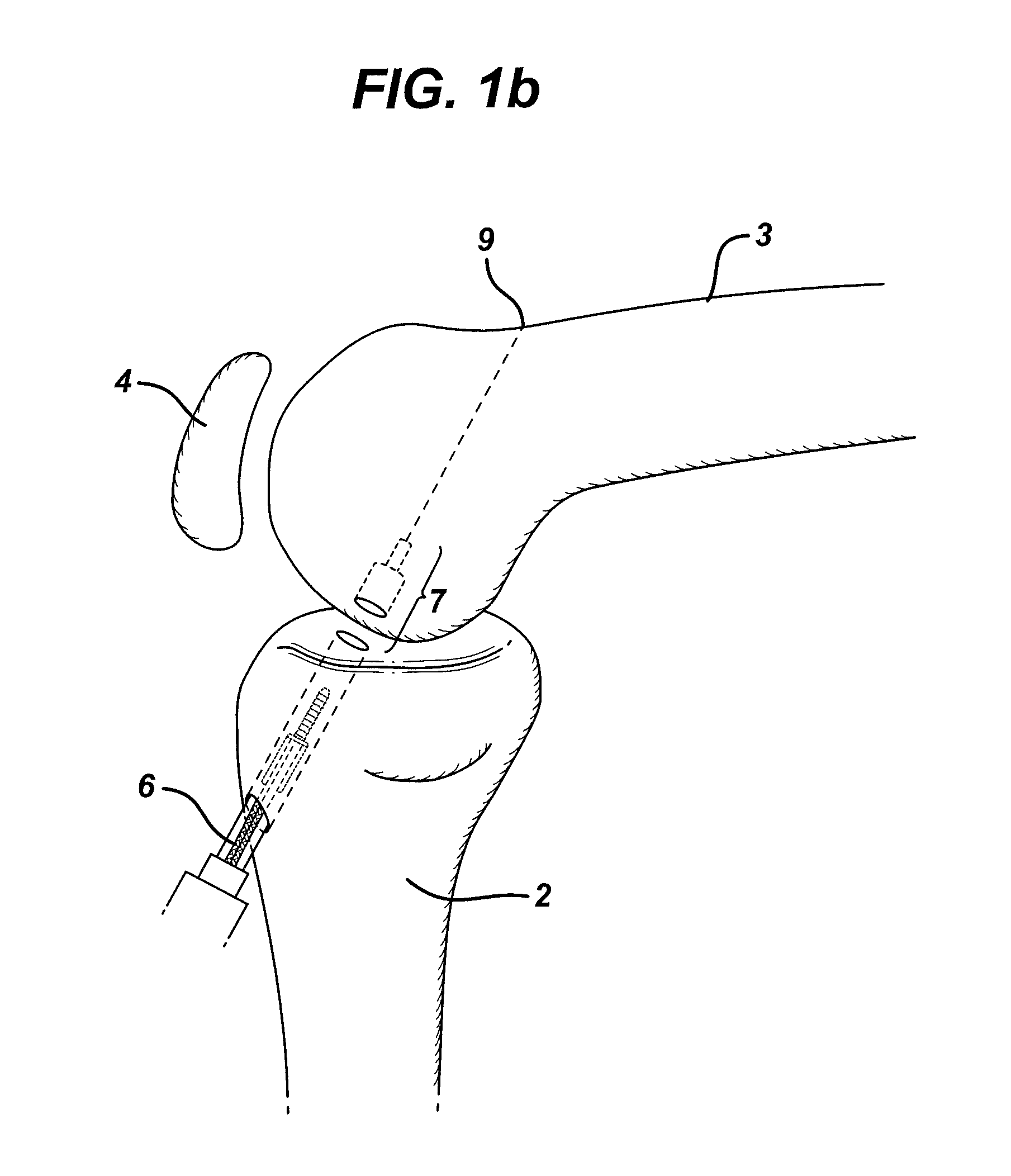 Method of anchoring autologous or artificial tendon grafts in bone