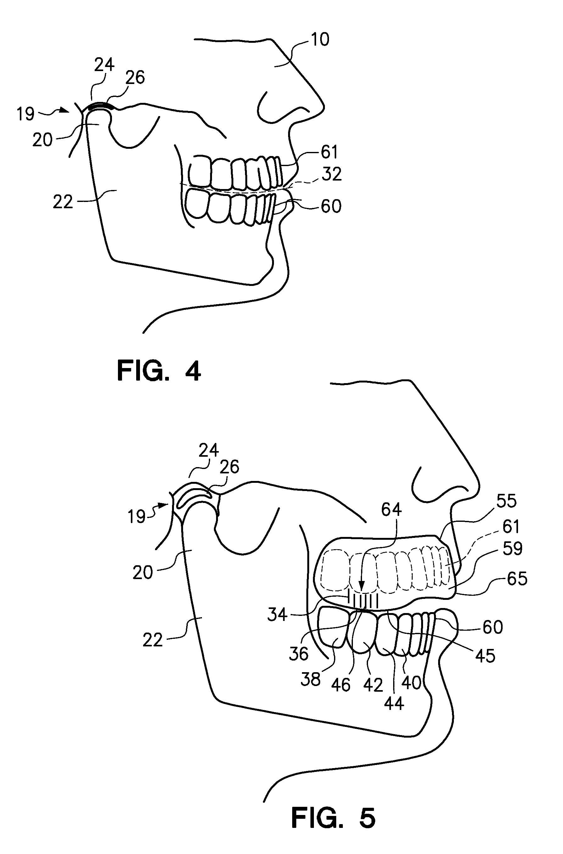 Mouthguard and method of manufacture therefor