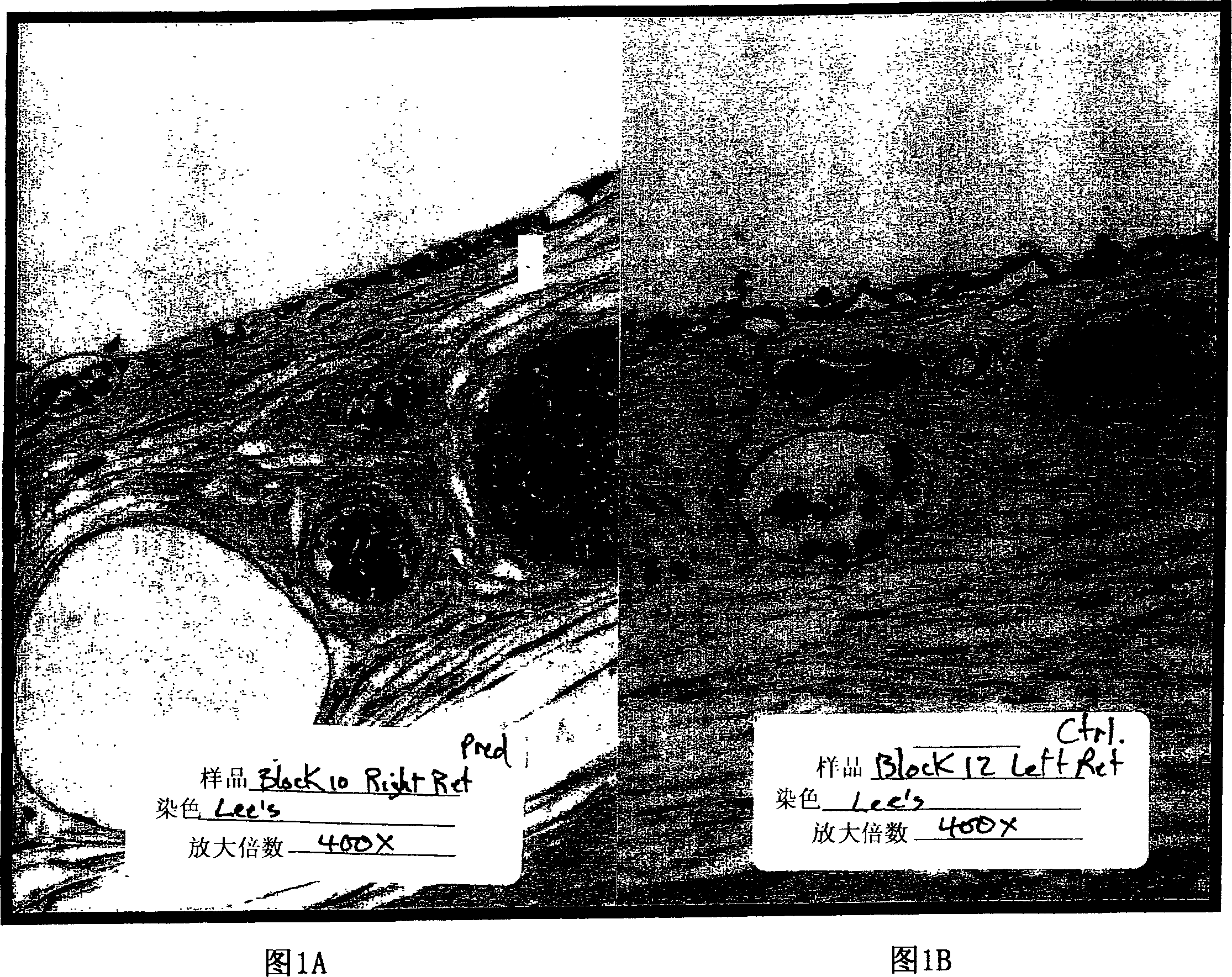 Methods and articles for the delivery of medicaments to the eye for the treatment of posterior segment diseases