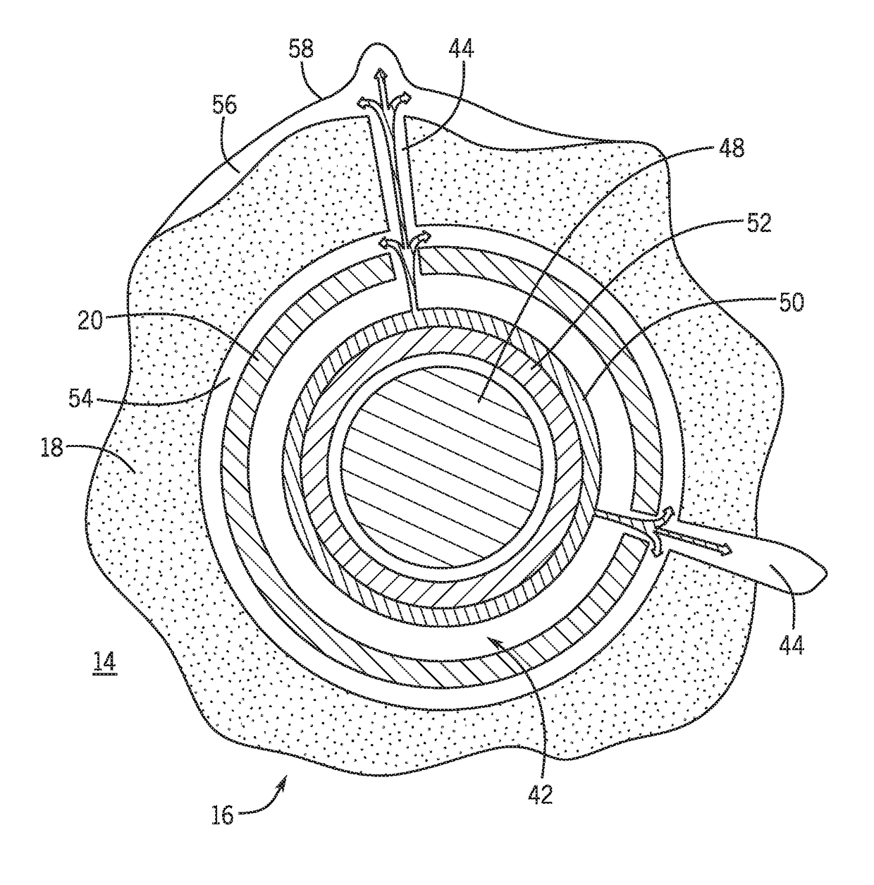 Systems and methods for remediating a microannulus in a wellbore