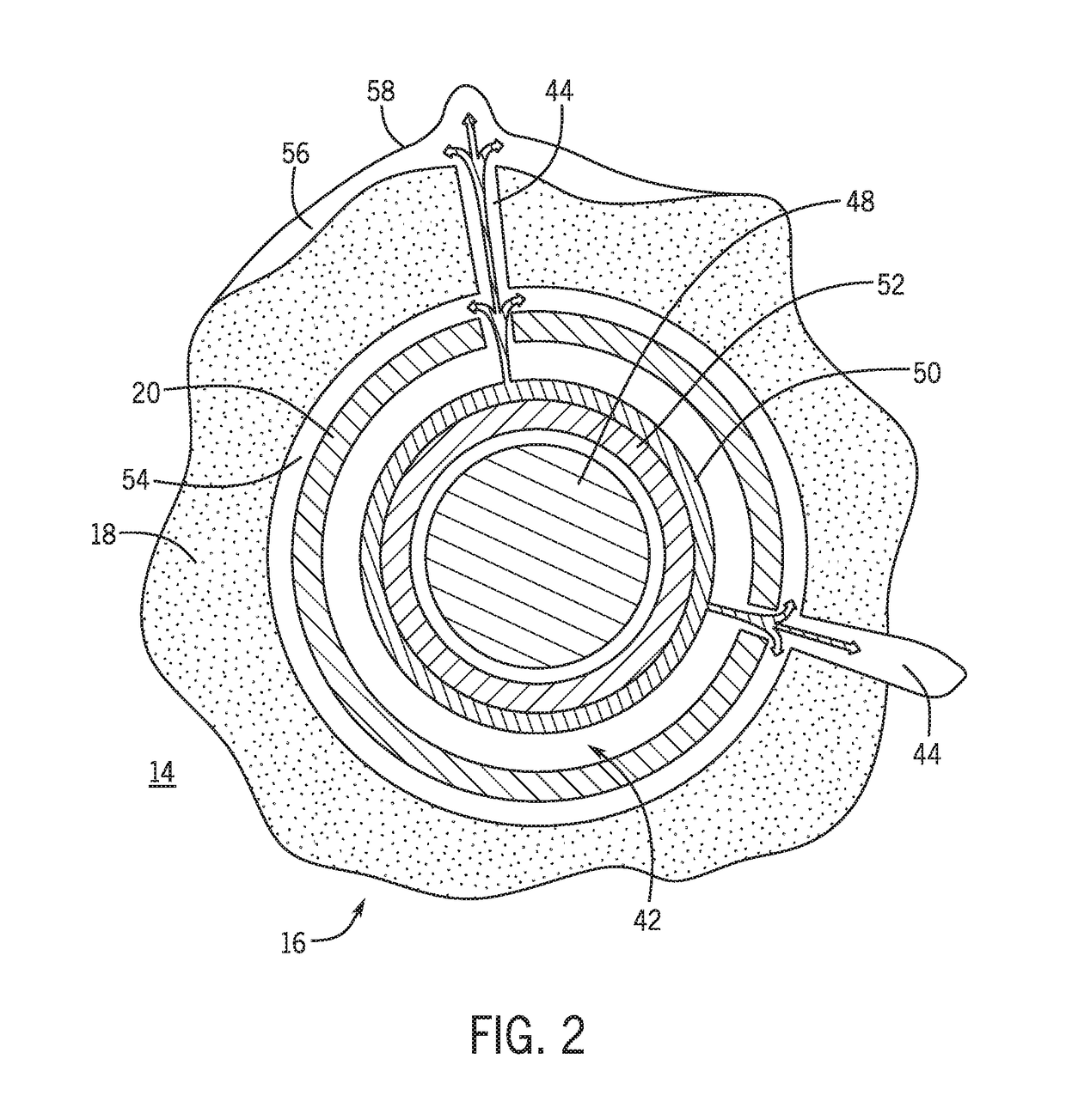 Systems and methods for remediating a microannulus in a wellbore