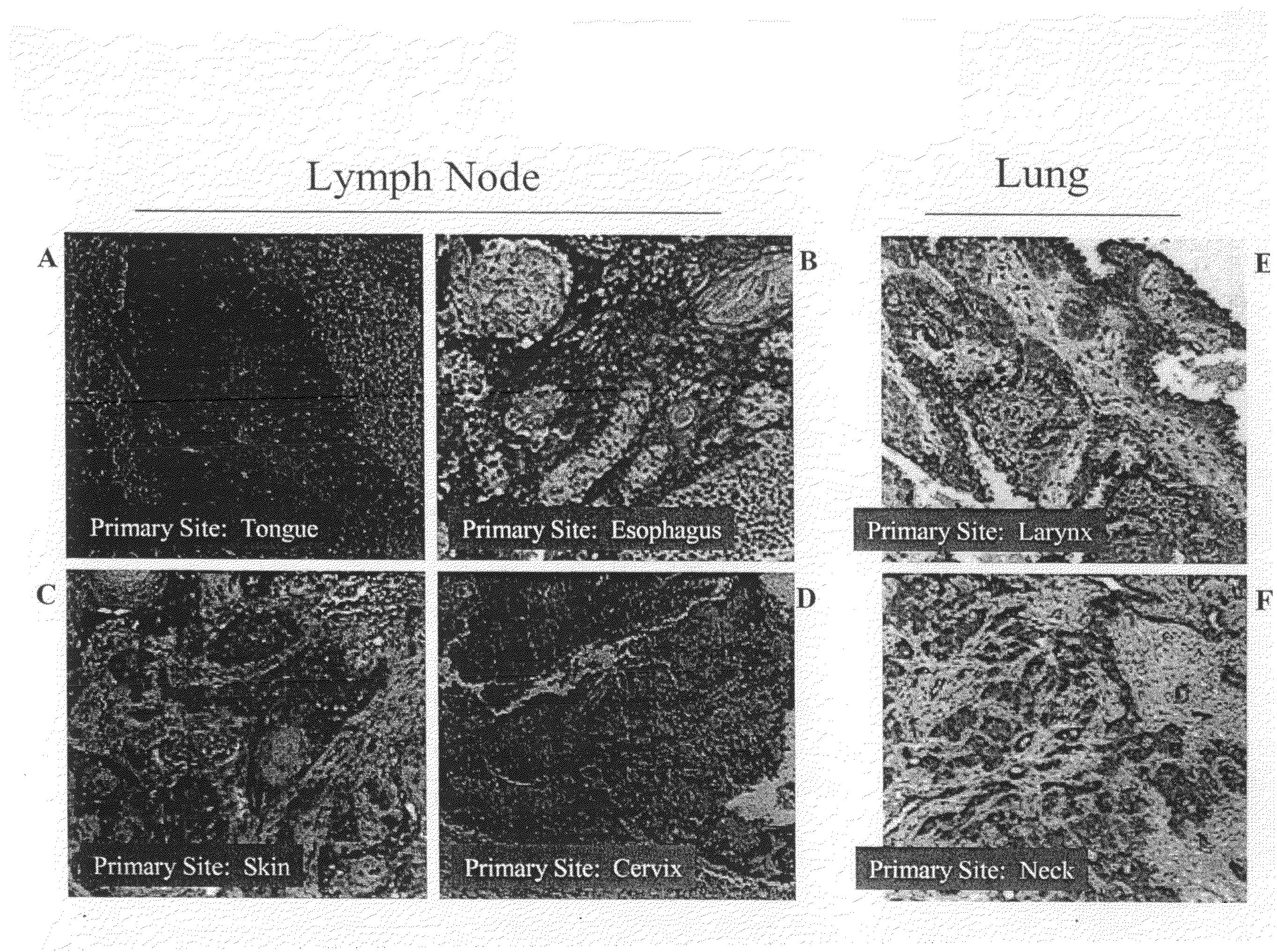 Compositions and methods for inhibiting growth of smad4-deficient cancers