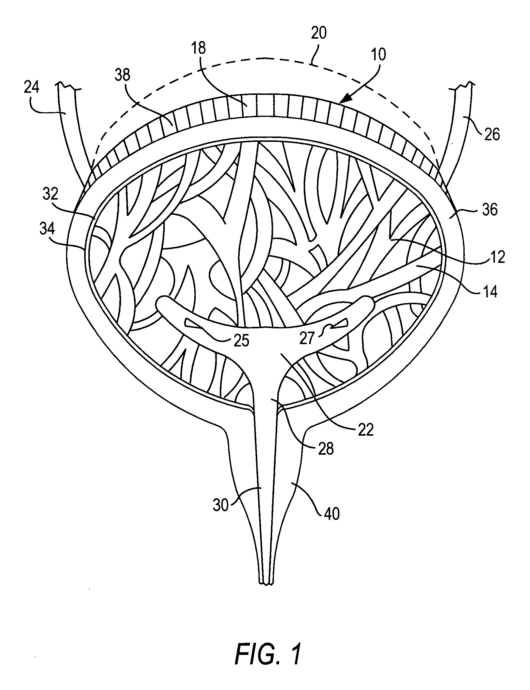 Method and system for intravesicular delivery of therapeutic agents