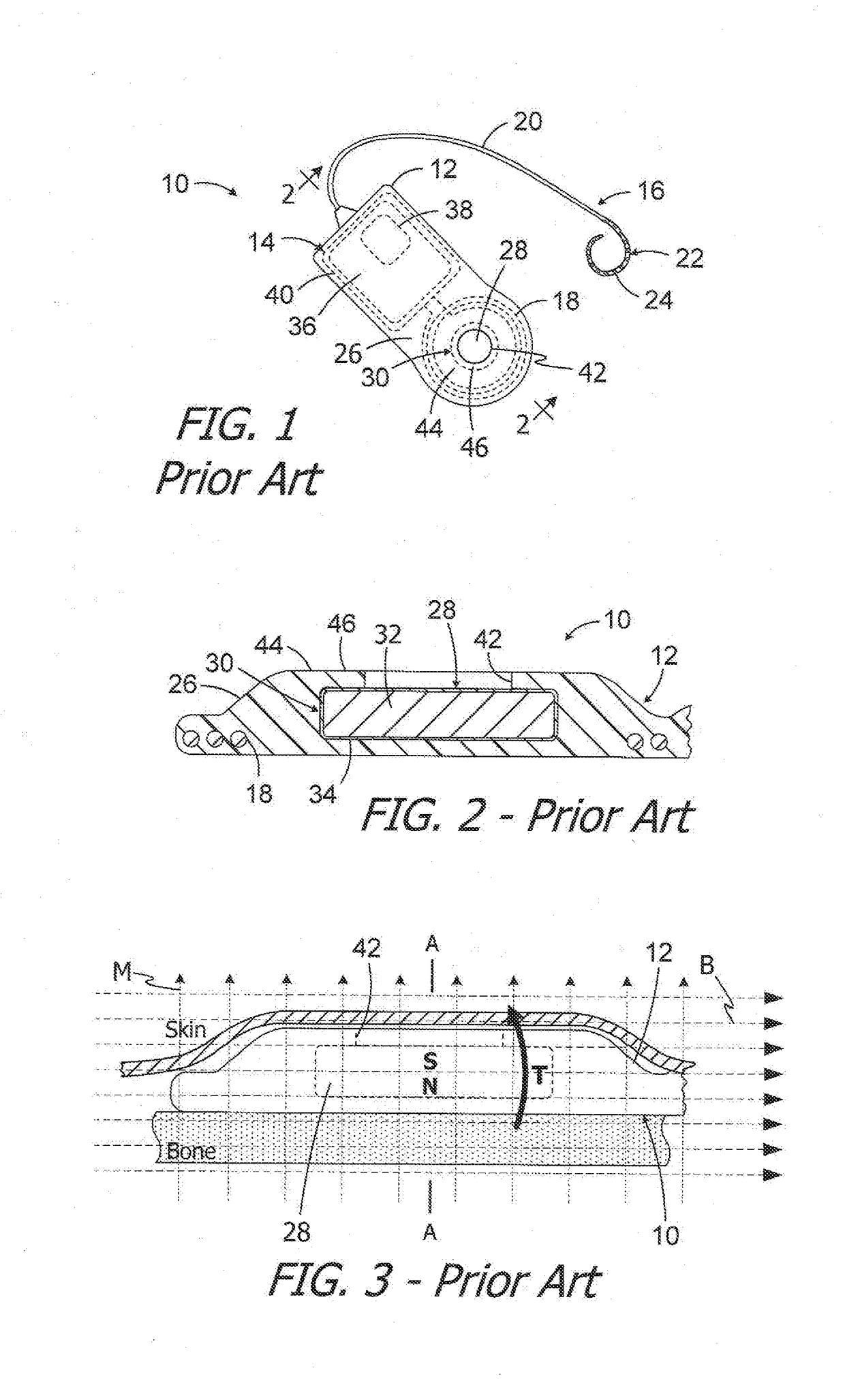 Magnet removal and replacement apparatus and methods for use with cochlear implants