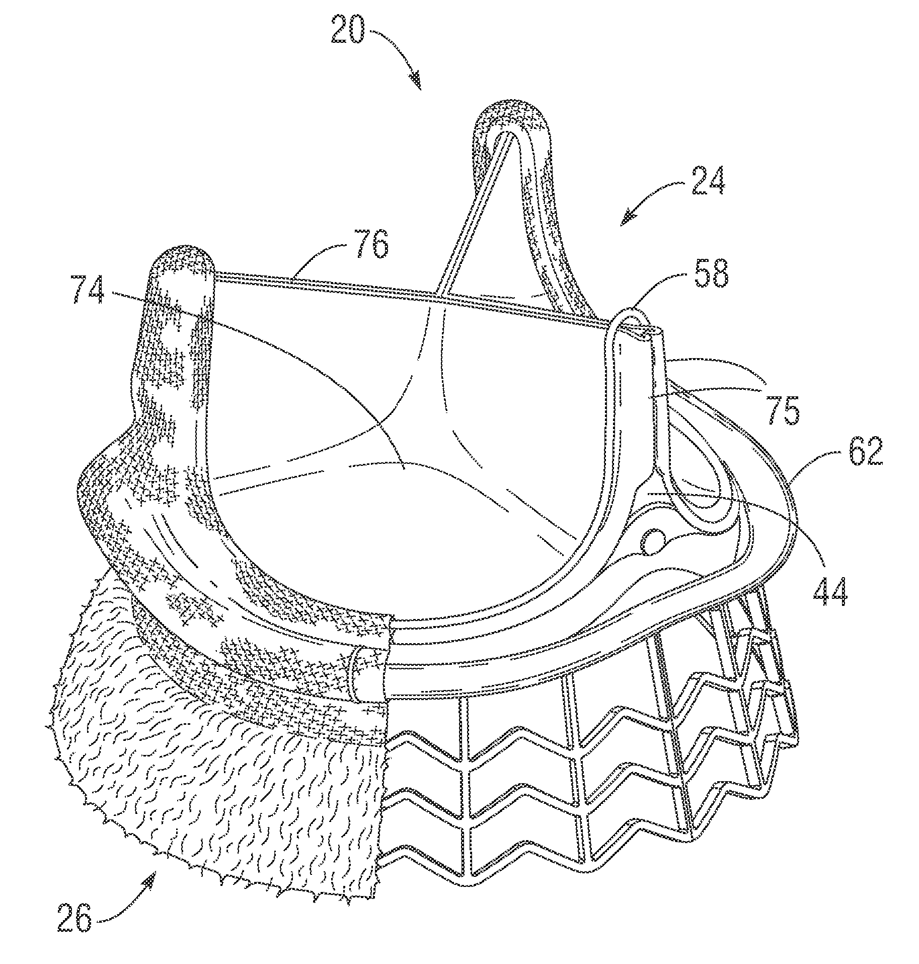 Rapidly deployable surgical heart valves