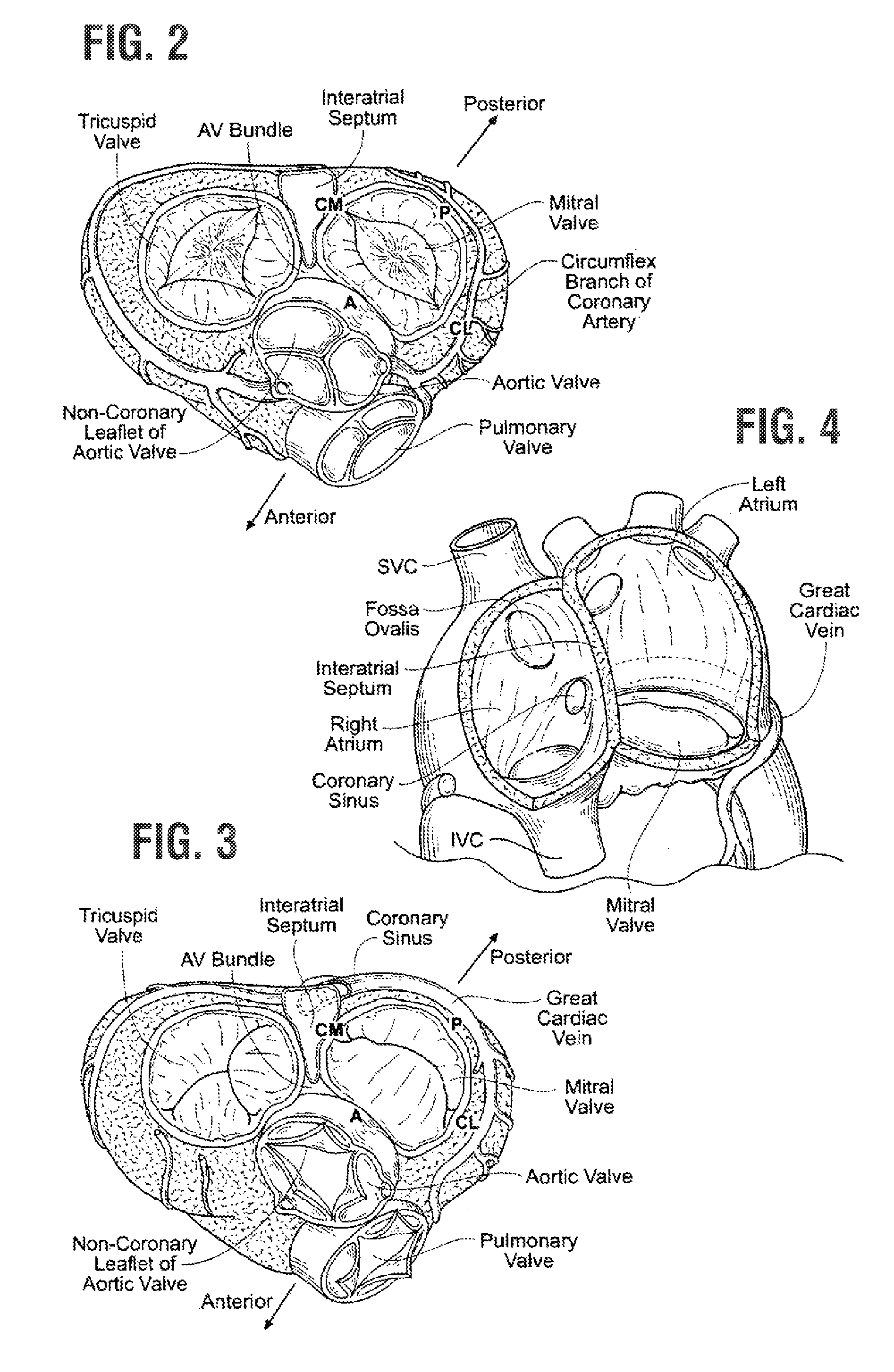 Rapidly deployable surgical heart valves