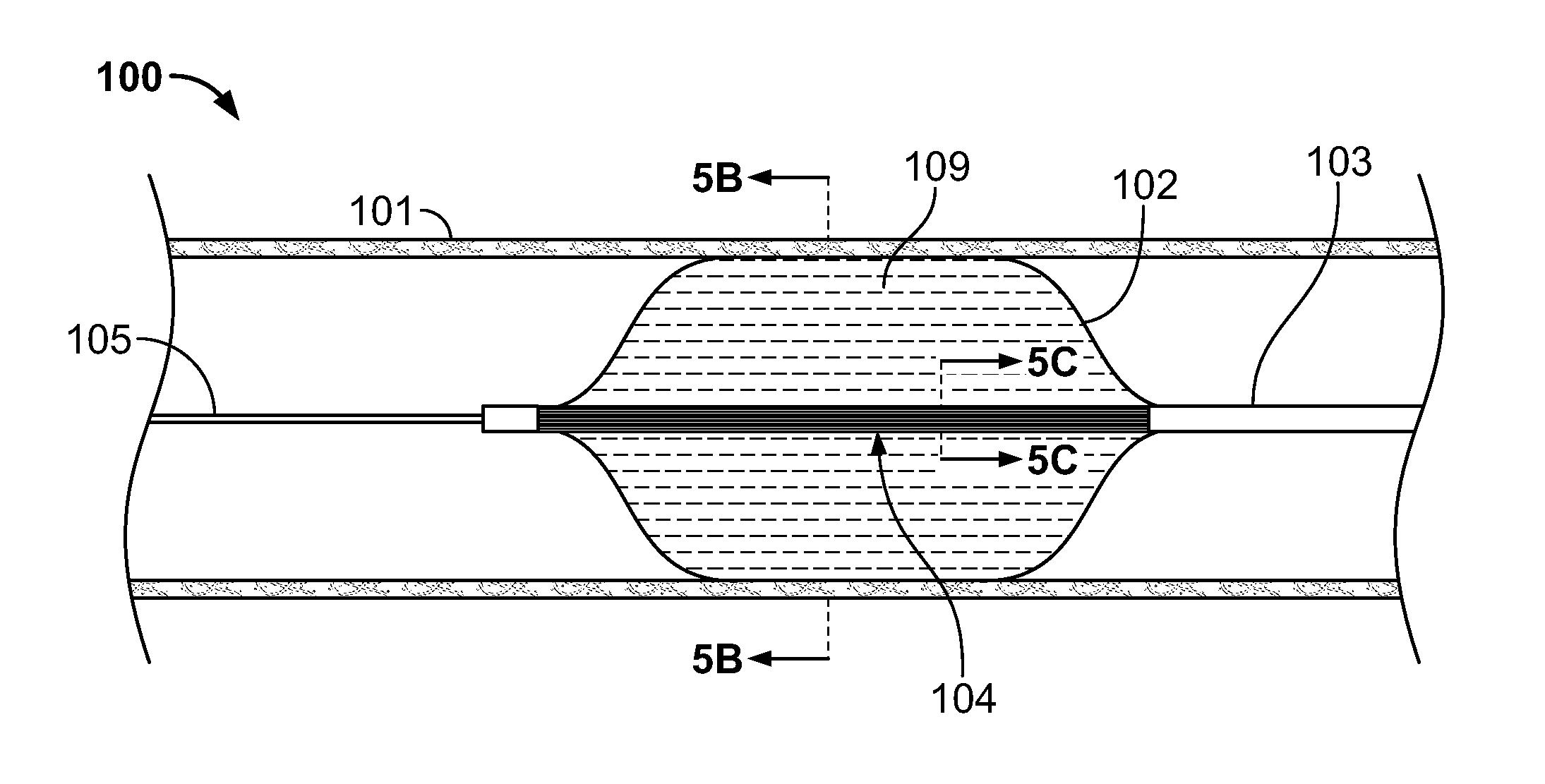 Cryo-induced renal neuromodulation devices and methods