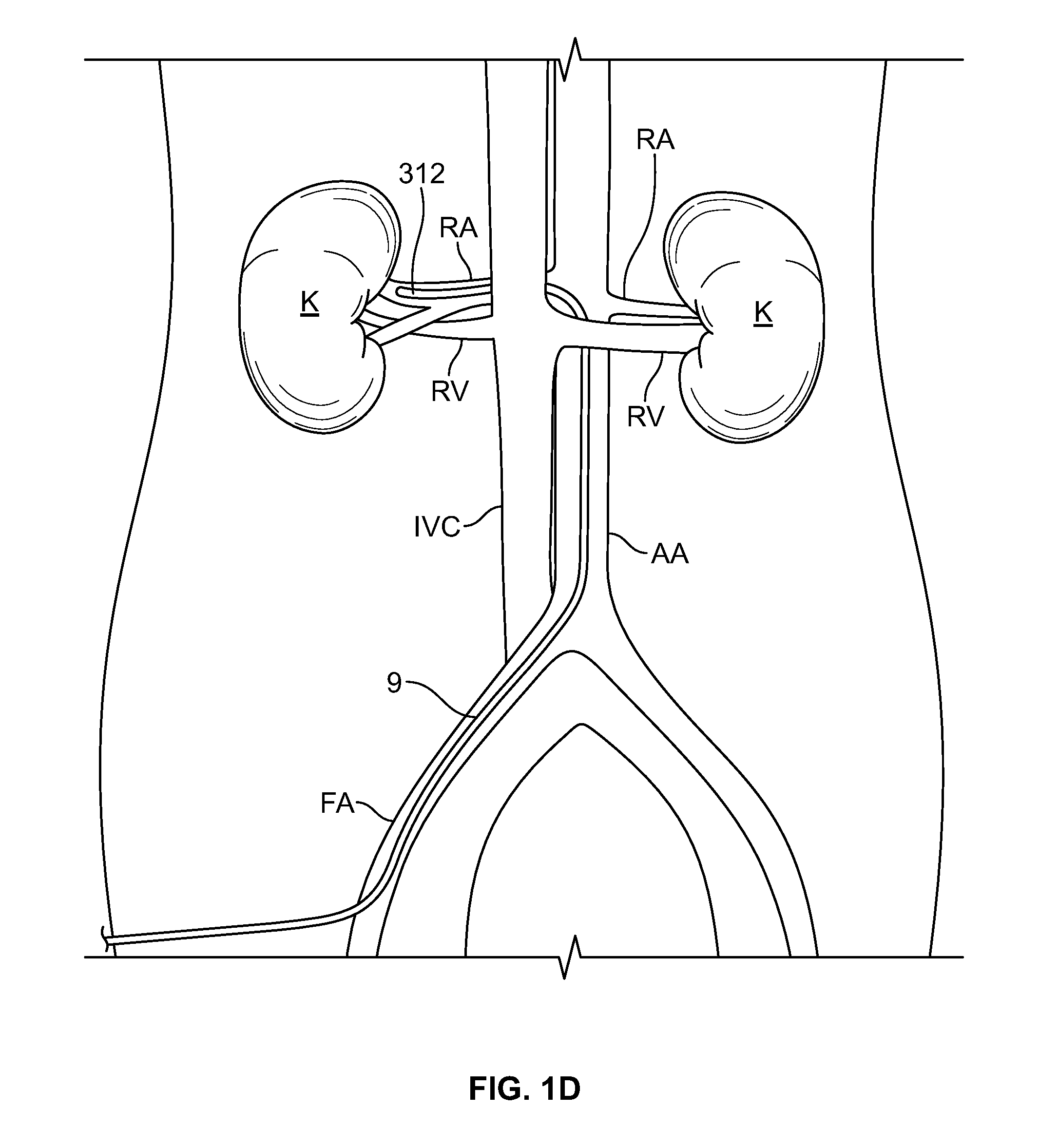 Cryo-induced renal neuromodulation devices and methods