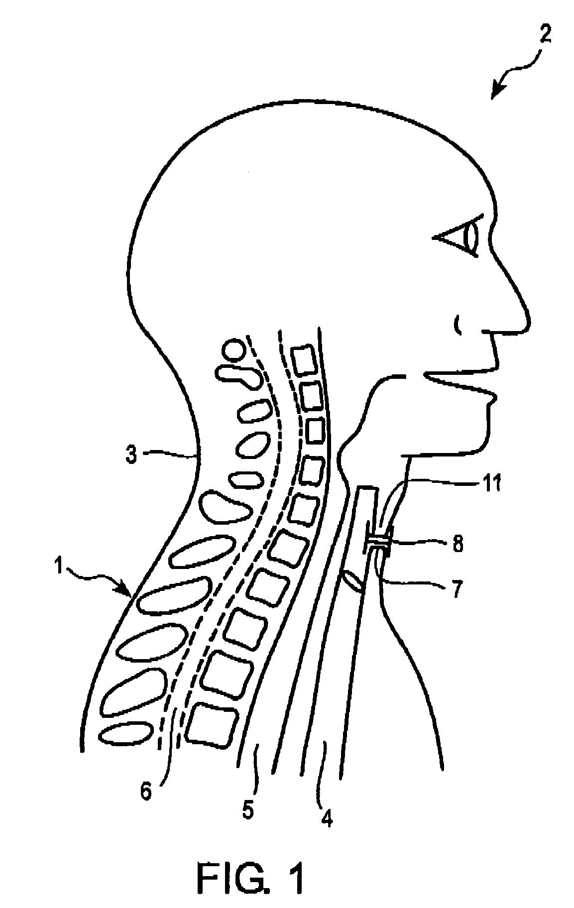 Tracheostoma spacer, tracheotomy method, and device for inserting a tracheostoma spacer