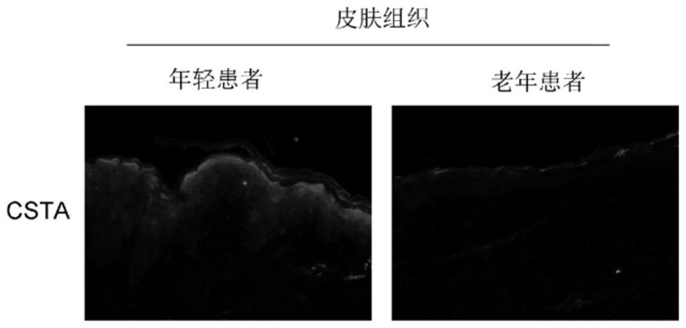 Application of calcipotriol as skin external medicine for preventing and treating senile osteoporosis