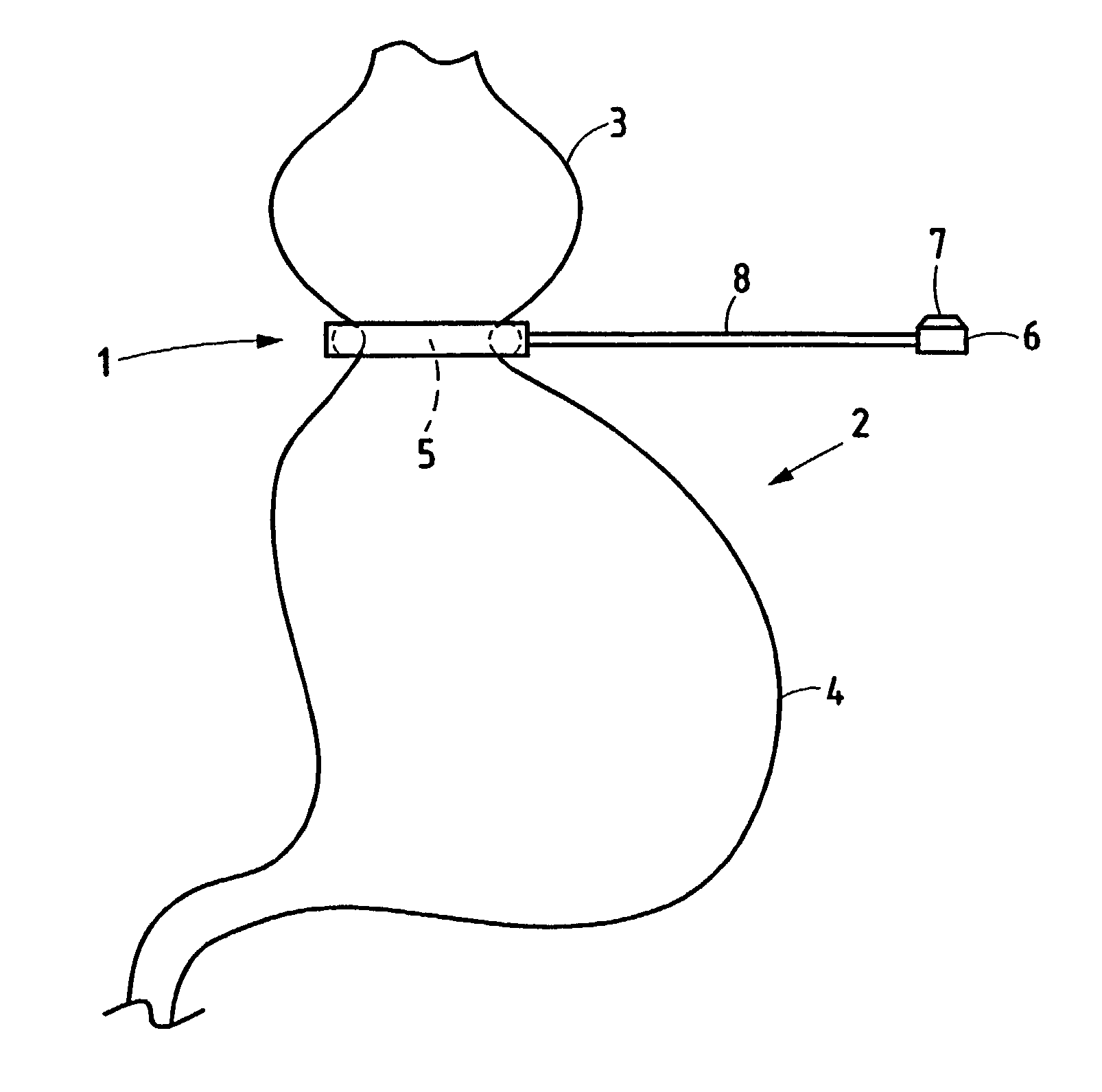 Adjustable gastric implant