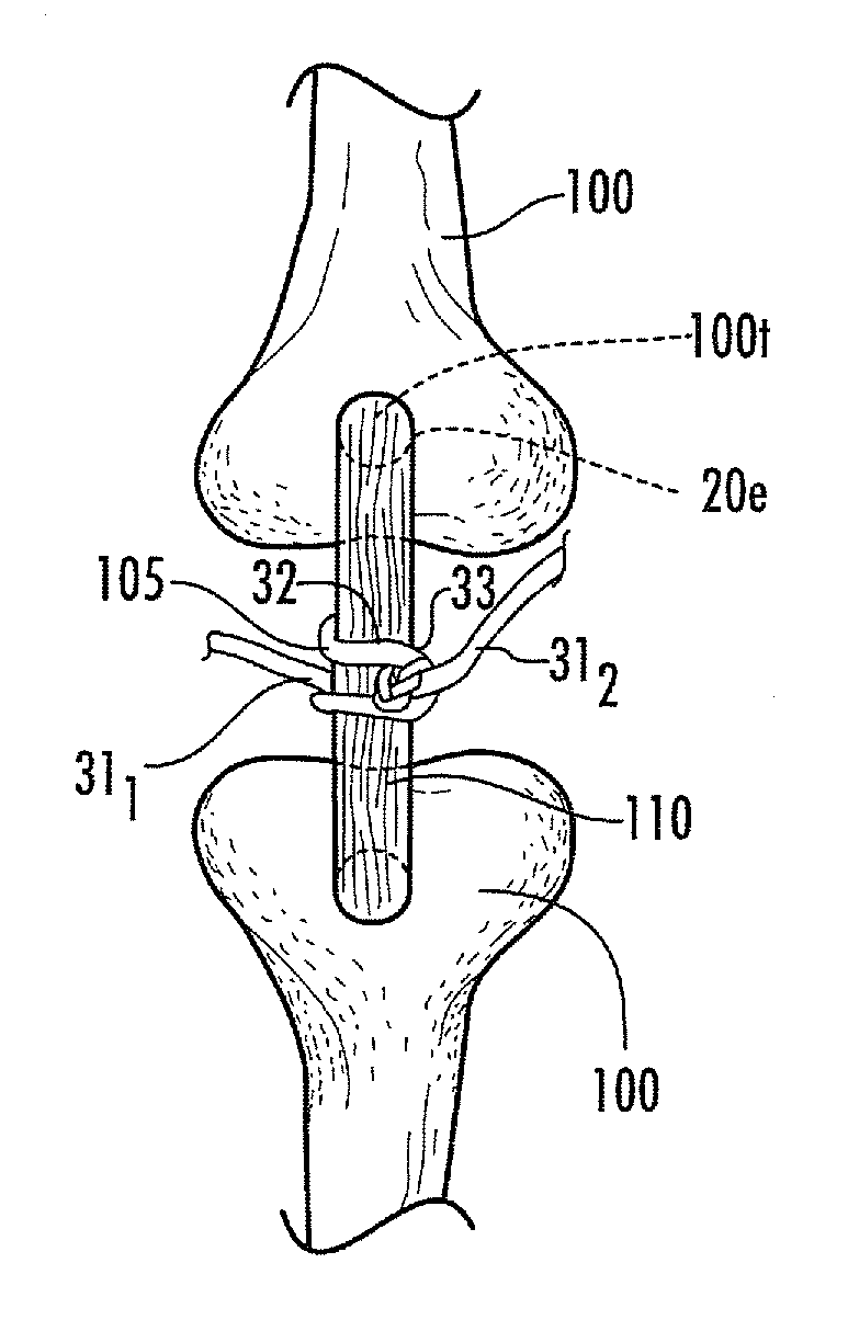 In vivo hydraulic fixation including bio-rivets using biocompatible expandable fibers