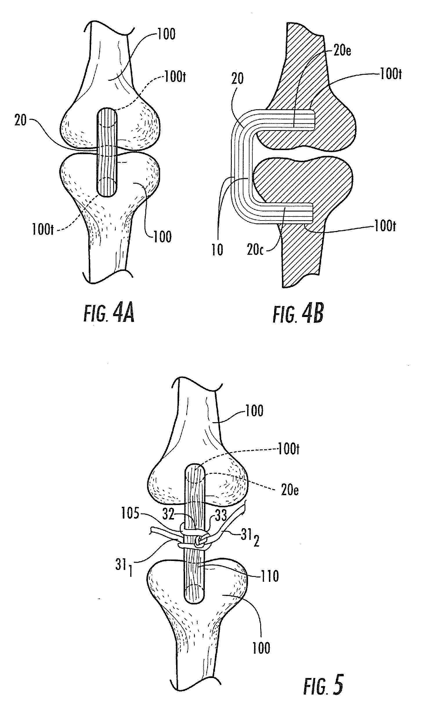 In vivo hydraulic fixation including bio-rivets using biocompatible expandable fibers