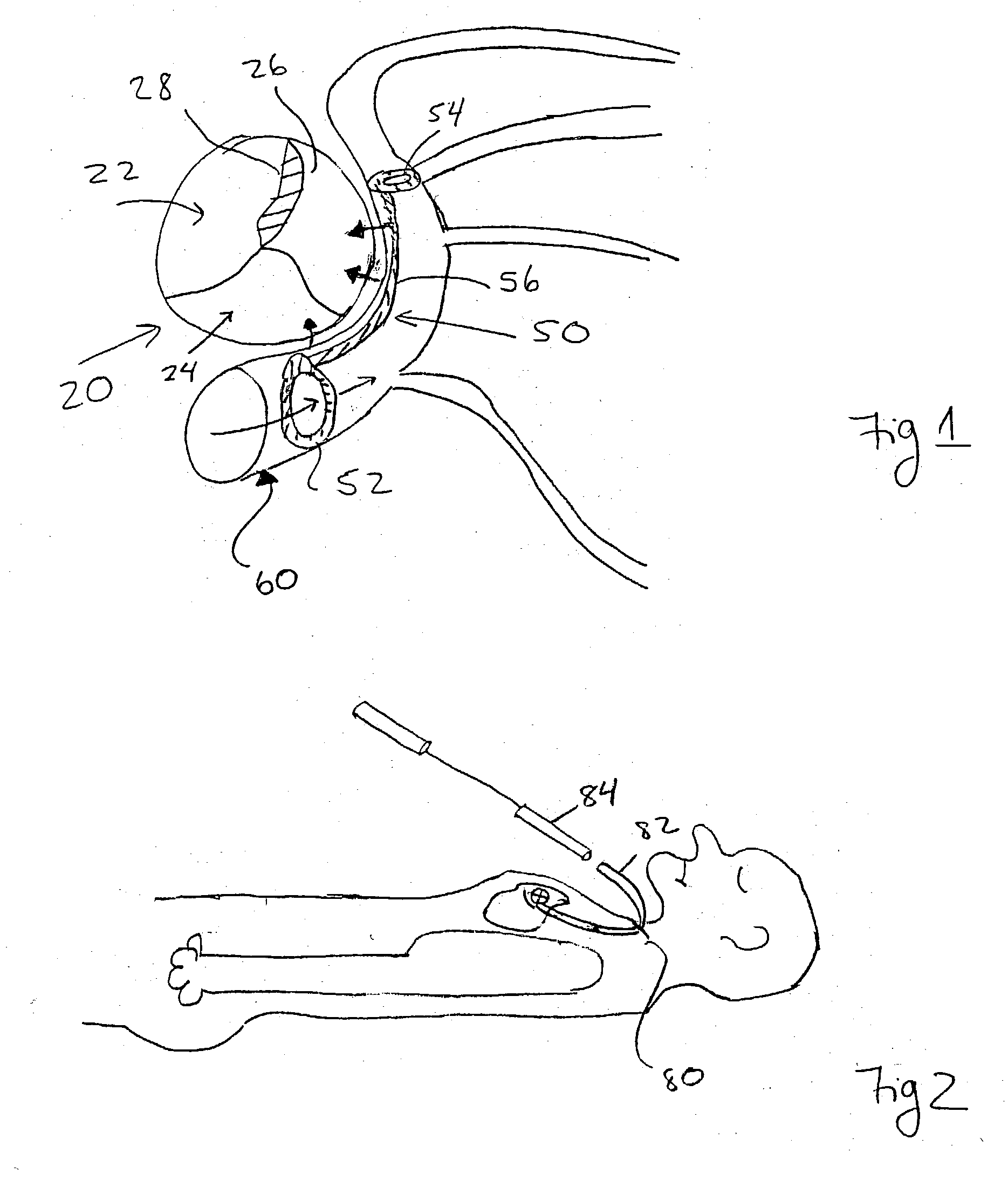 Device and method for modifying the shape of a body organ