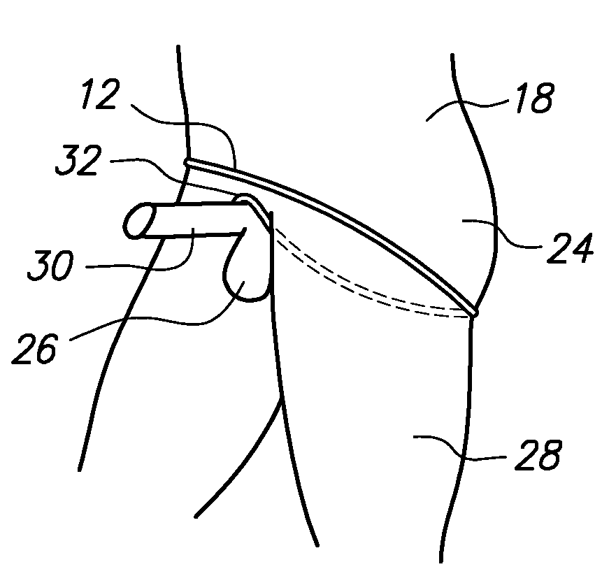 Method of Treating Erectile Dysfunction