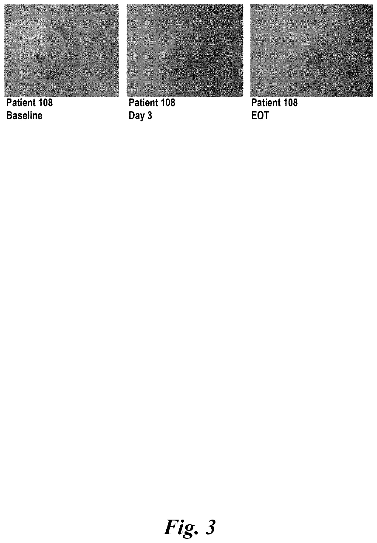 Method for healing of an infected acne lesion without scarring