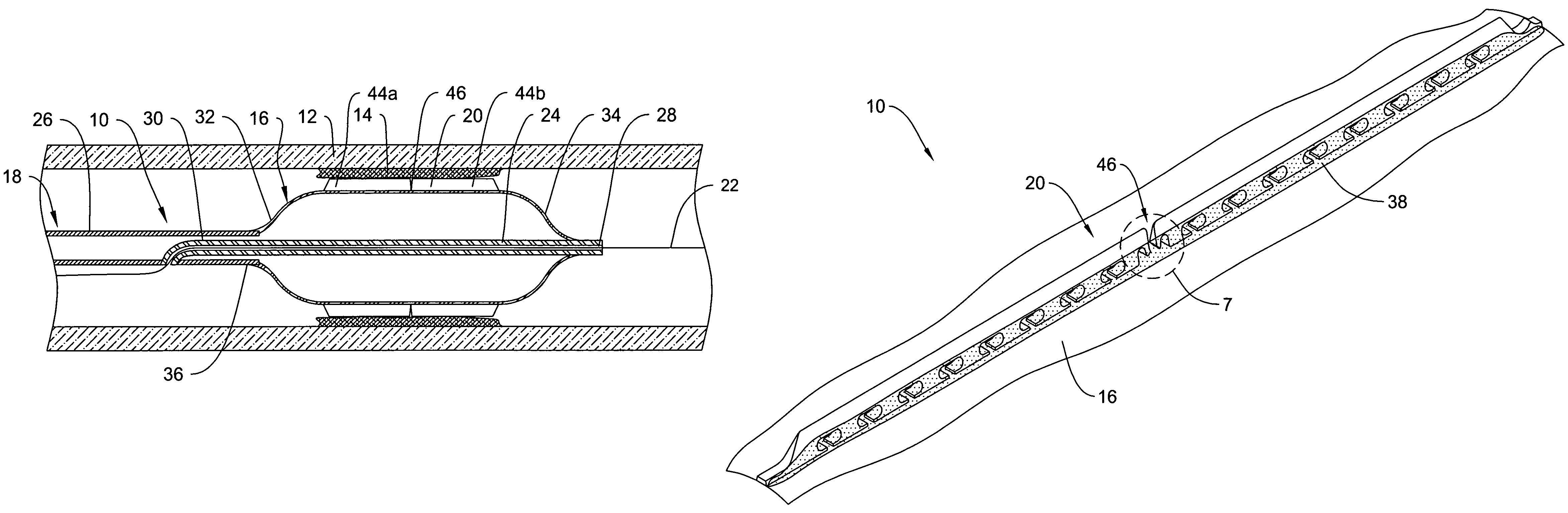 Cutting balloon catheter having a segmented blade