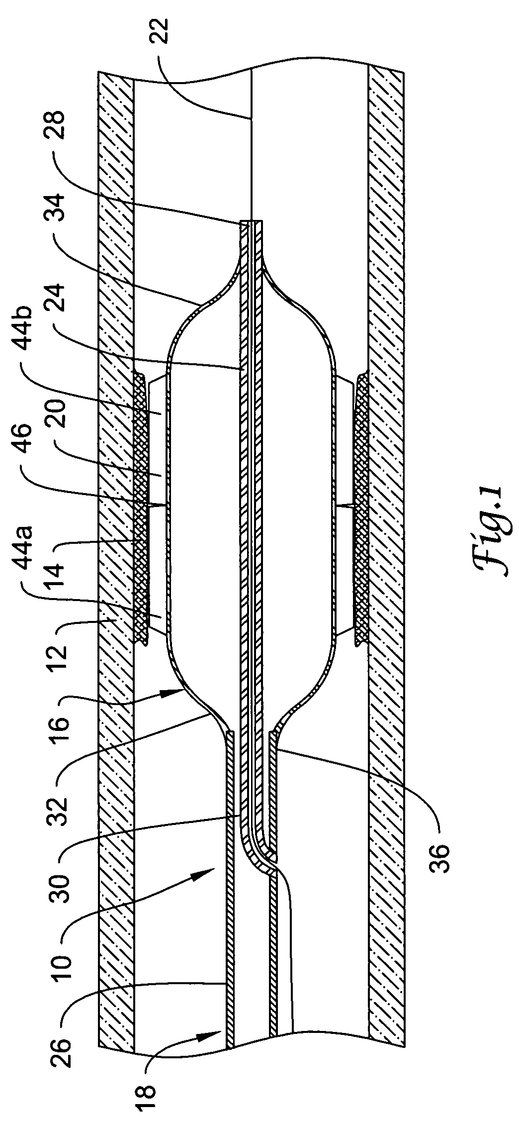 Cutting balloon catheter having a segmented blade