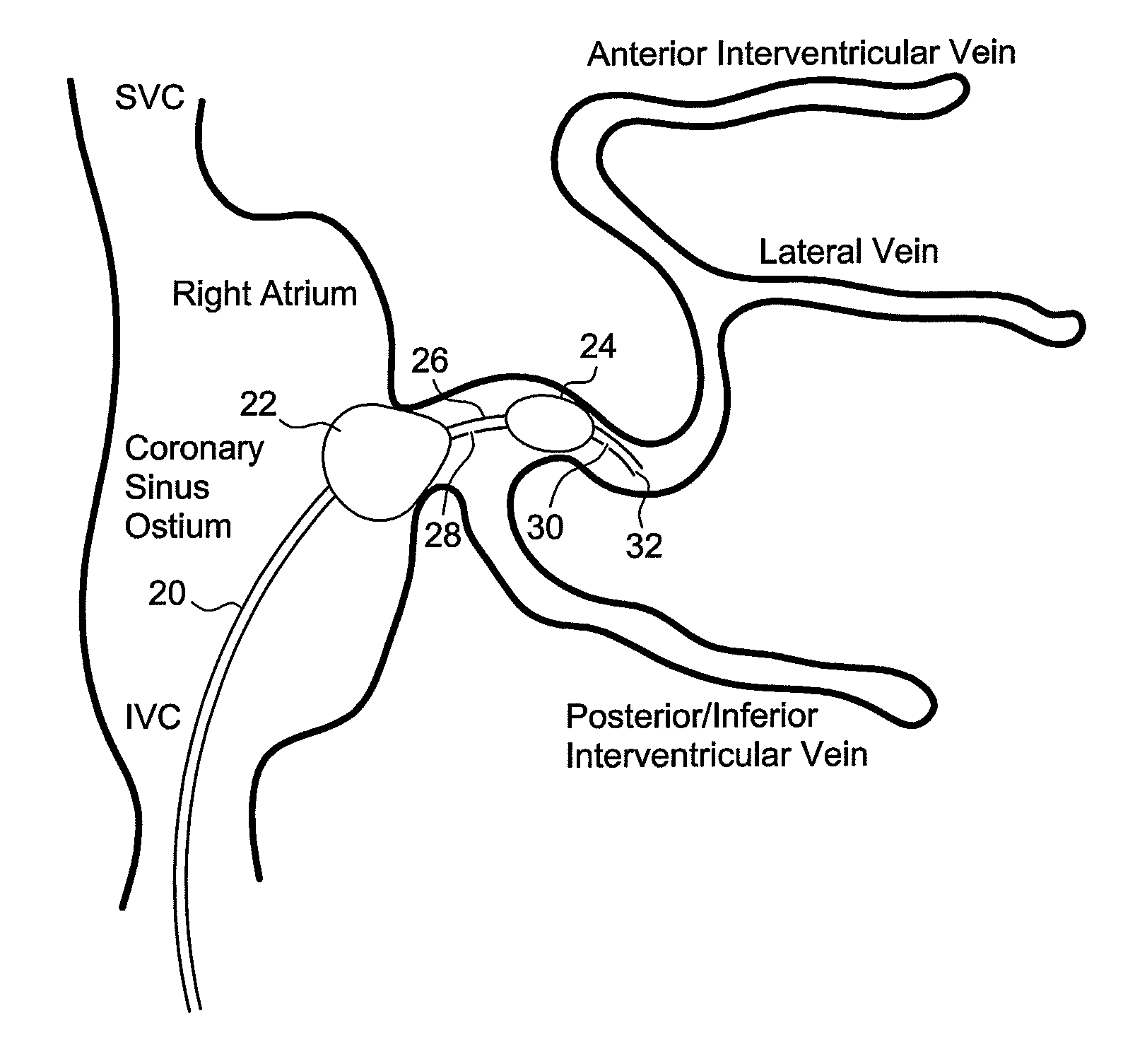 Method and system for preventing contrast associated nephropathy