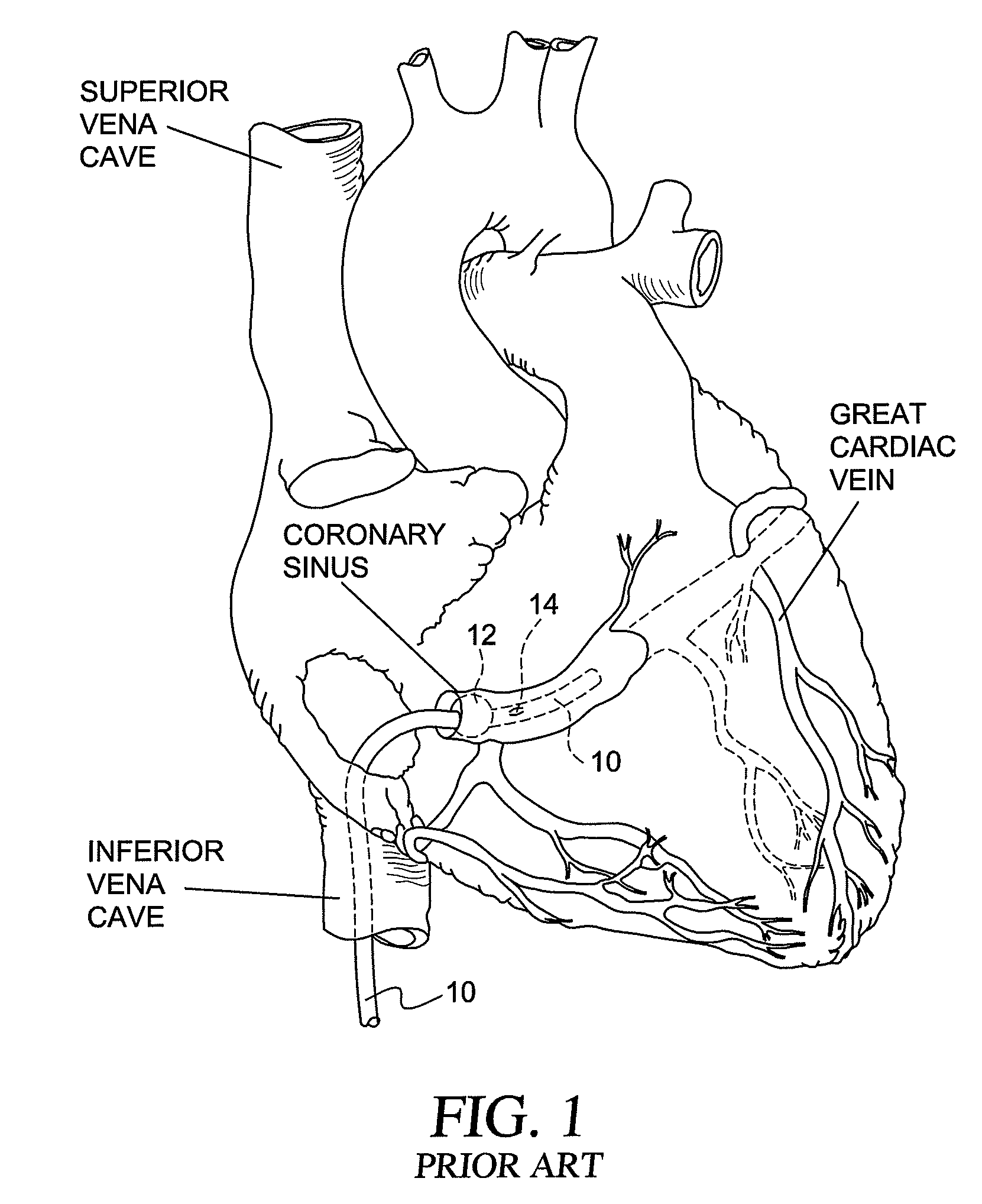 Method and system for preventing contrast associated nephropathy