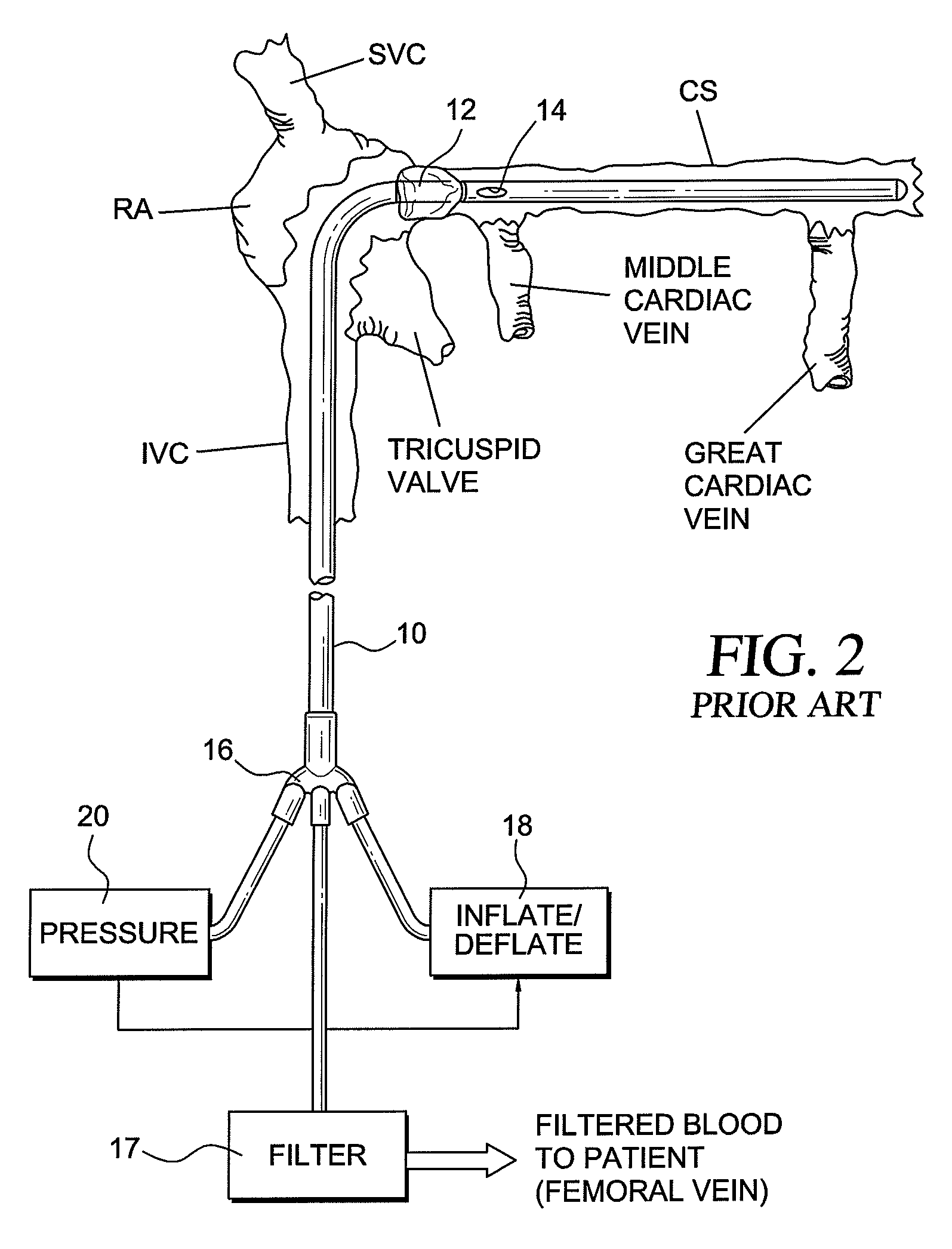 Method and system for preventing contrast associated nephropathy