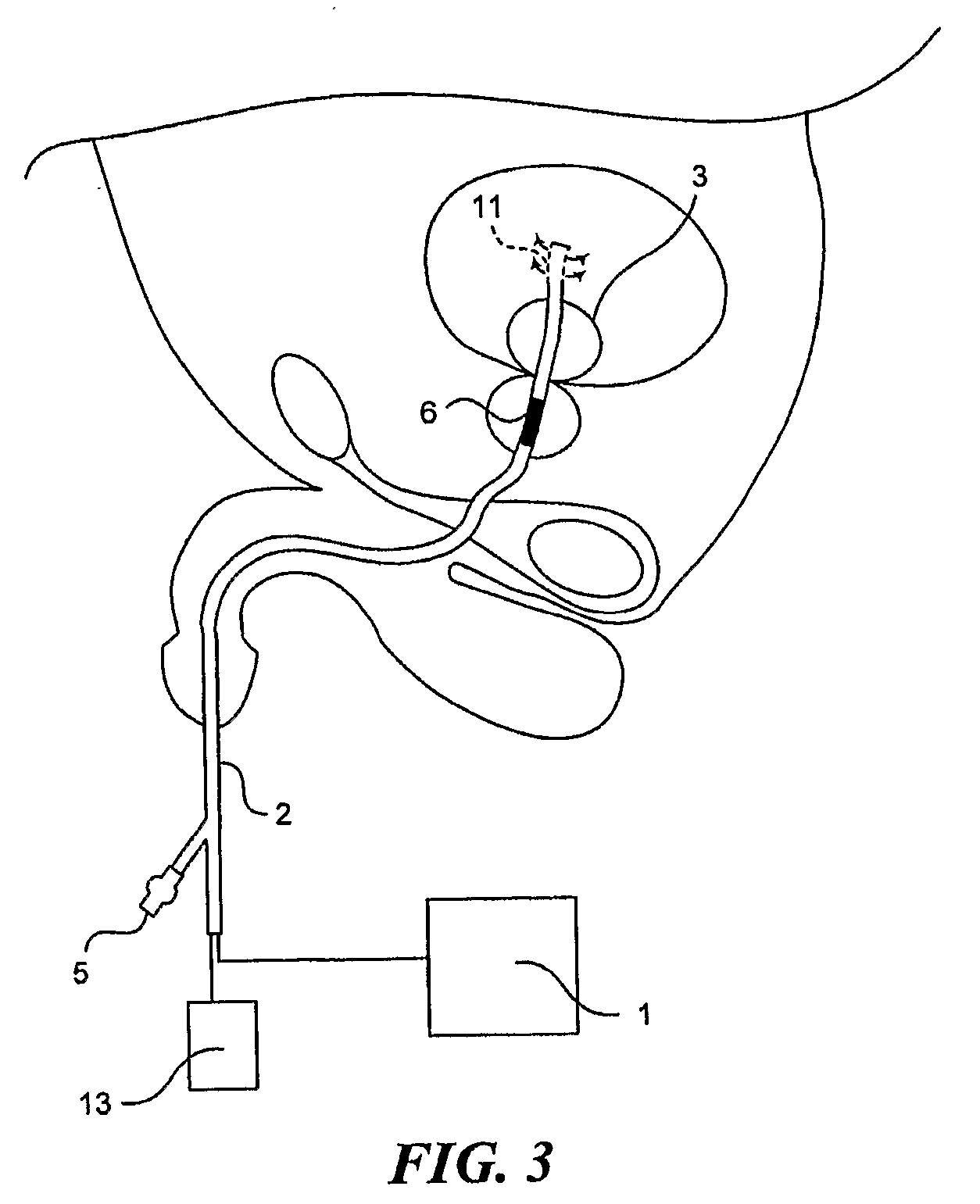 Method and apparatus for light-activated drug therapy