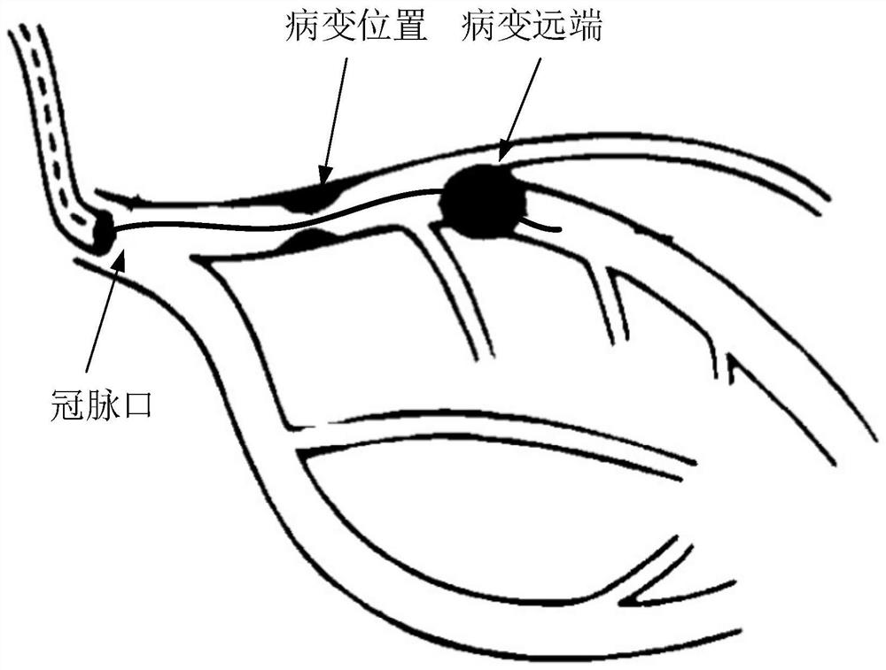 Diagnosis and treatment catheter for vascular lesion area