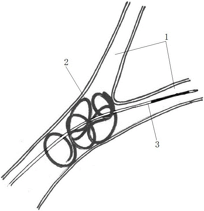 An intravascular foreign body fishing device