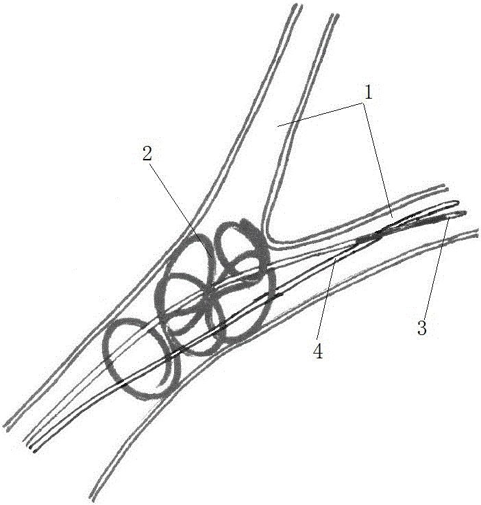 An intravascular foreign body fishing device