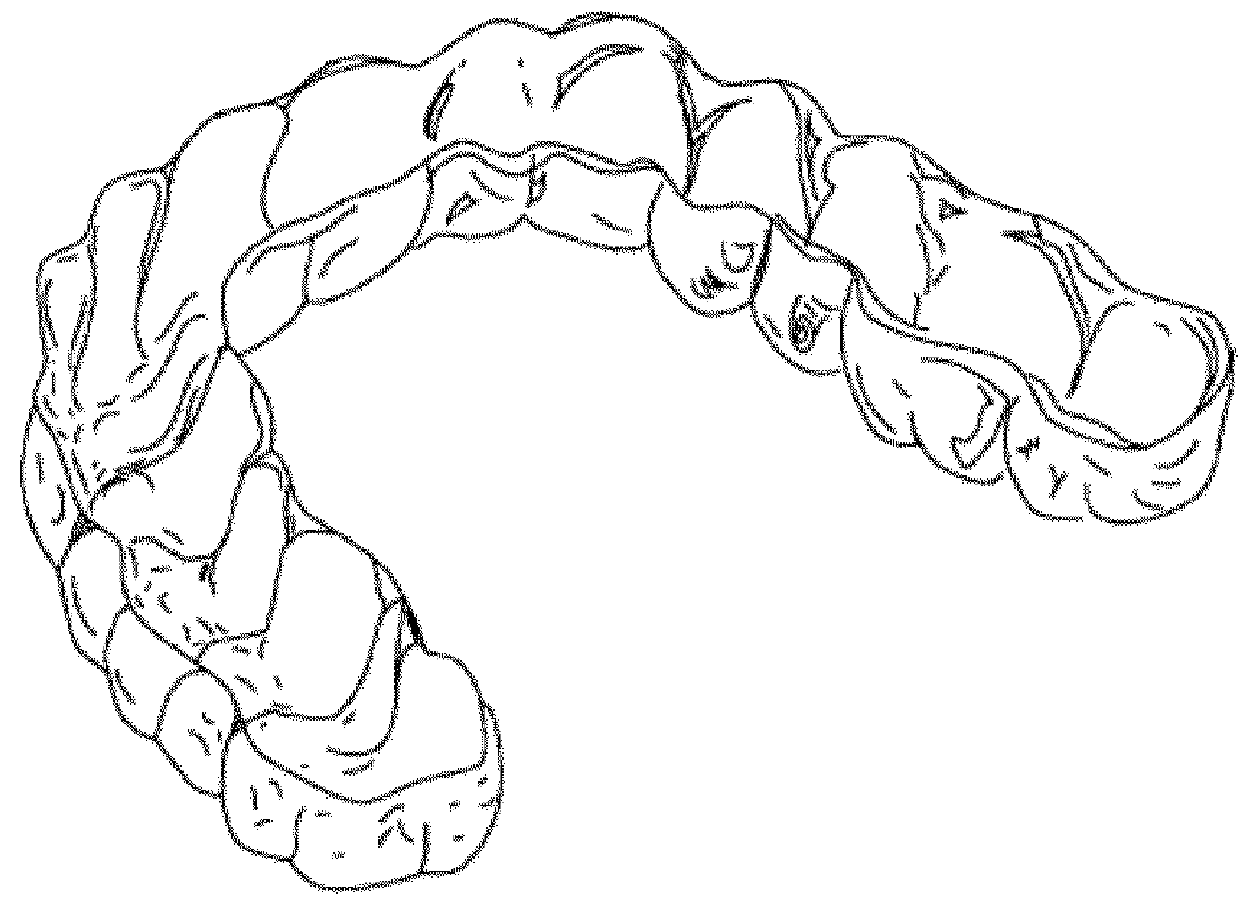 Dental treatment method combining tooth positioners and arch aligners