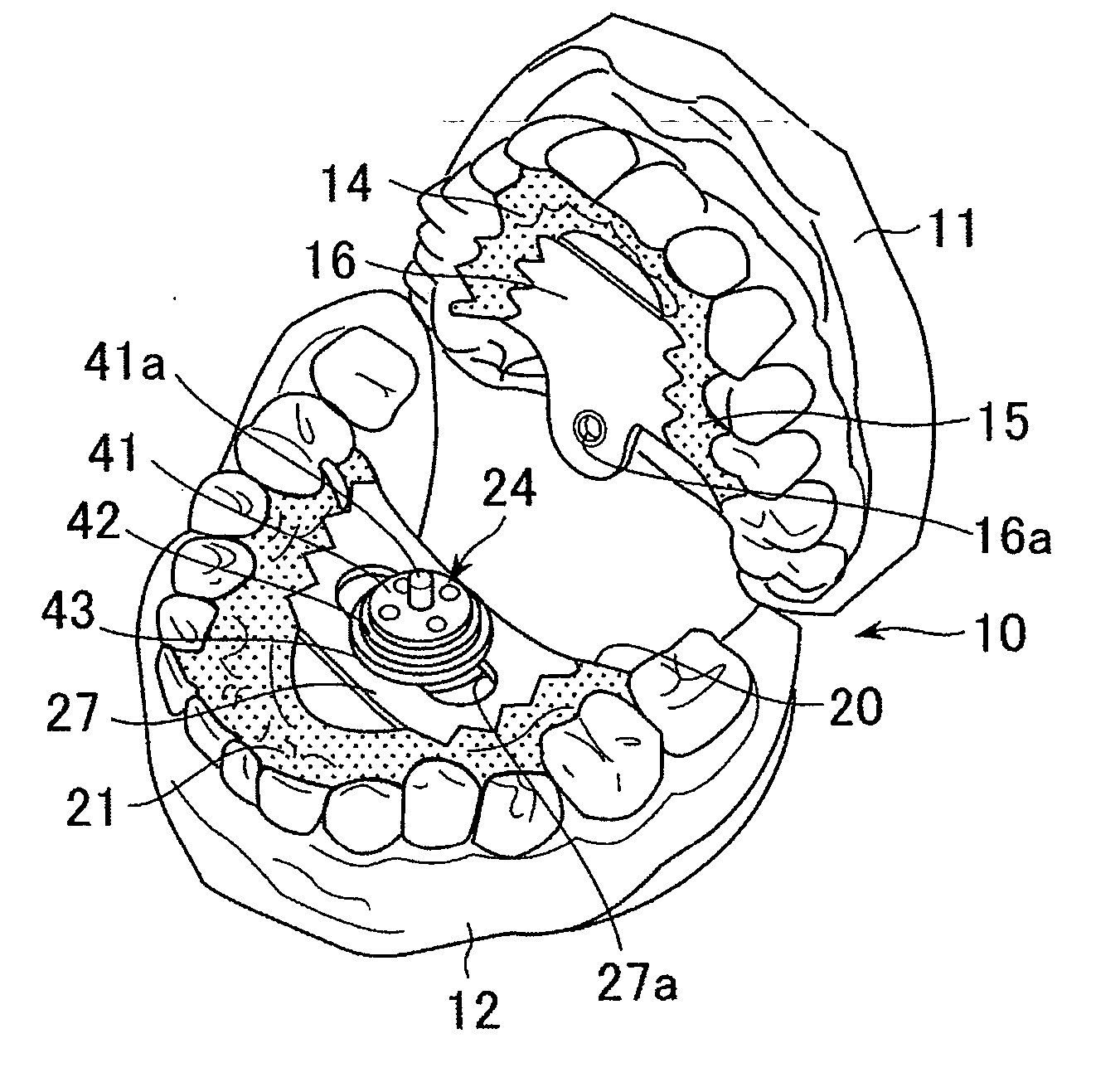 Occlusion correction improvement instrument and correction improvement method using the instrument