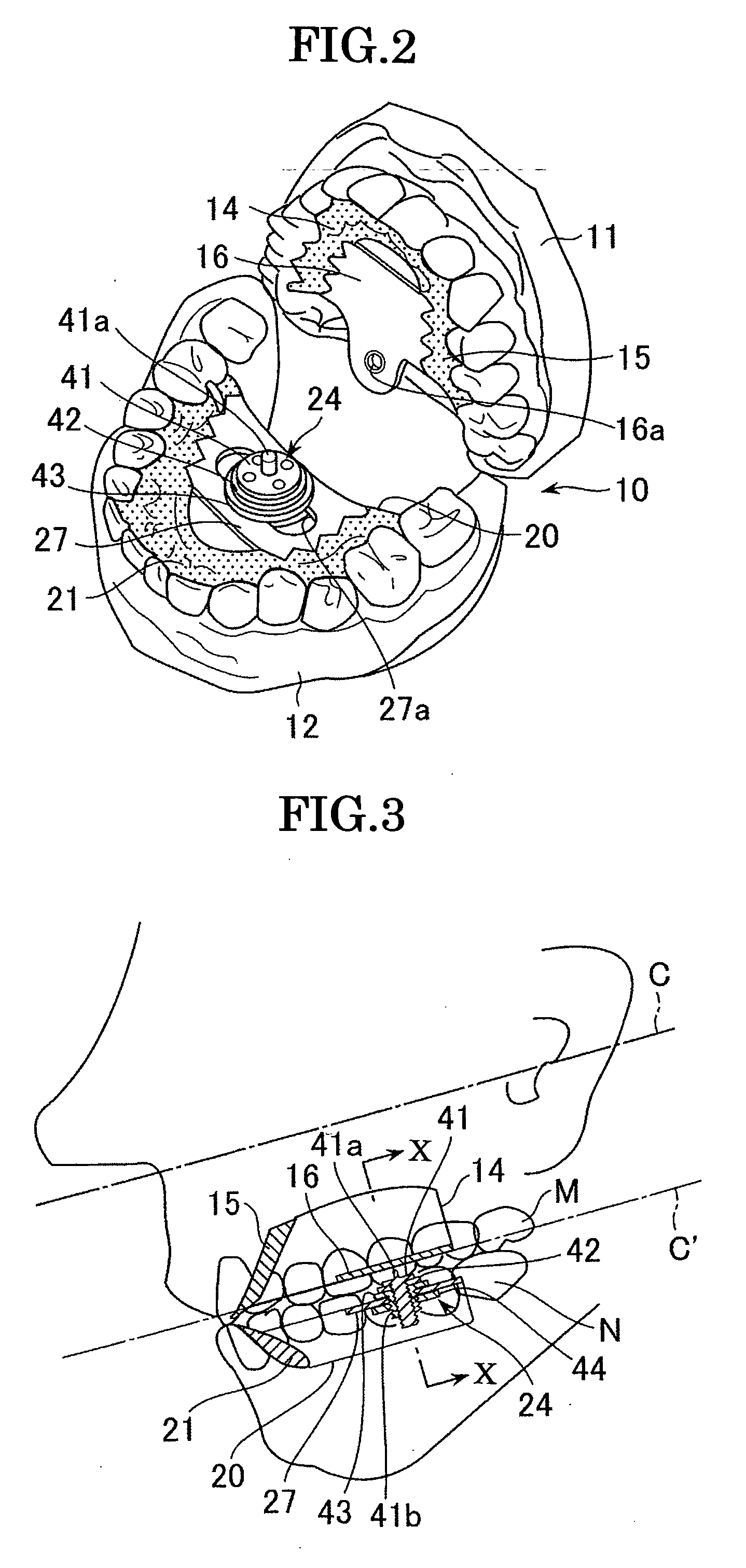 Occlusion correction improvement instrument and correction improvement method using the instrument