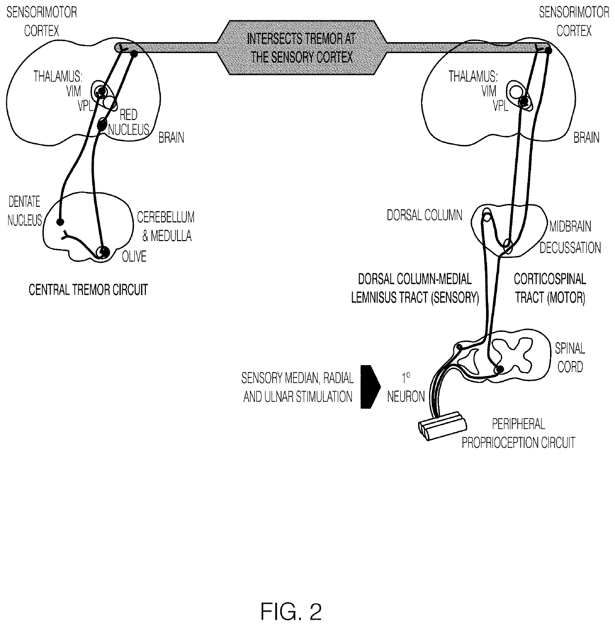 Systems and methods for peripheral nerve stimulation in the finger or hand to treat hand tremors