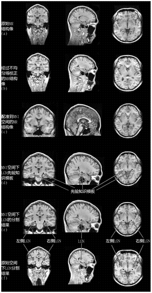 Method for automatically segmenting human lateral geniculate nucleus (LGN) by using prior knowledge