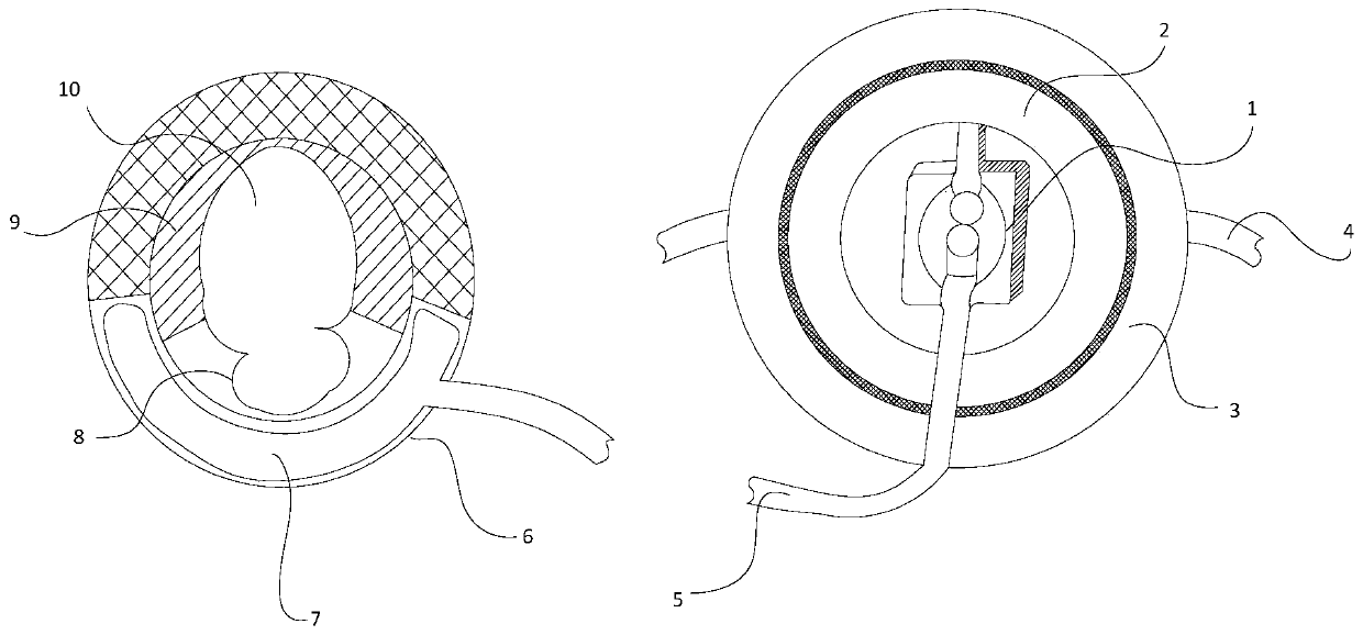 External artificial urethral sphincter device