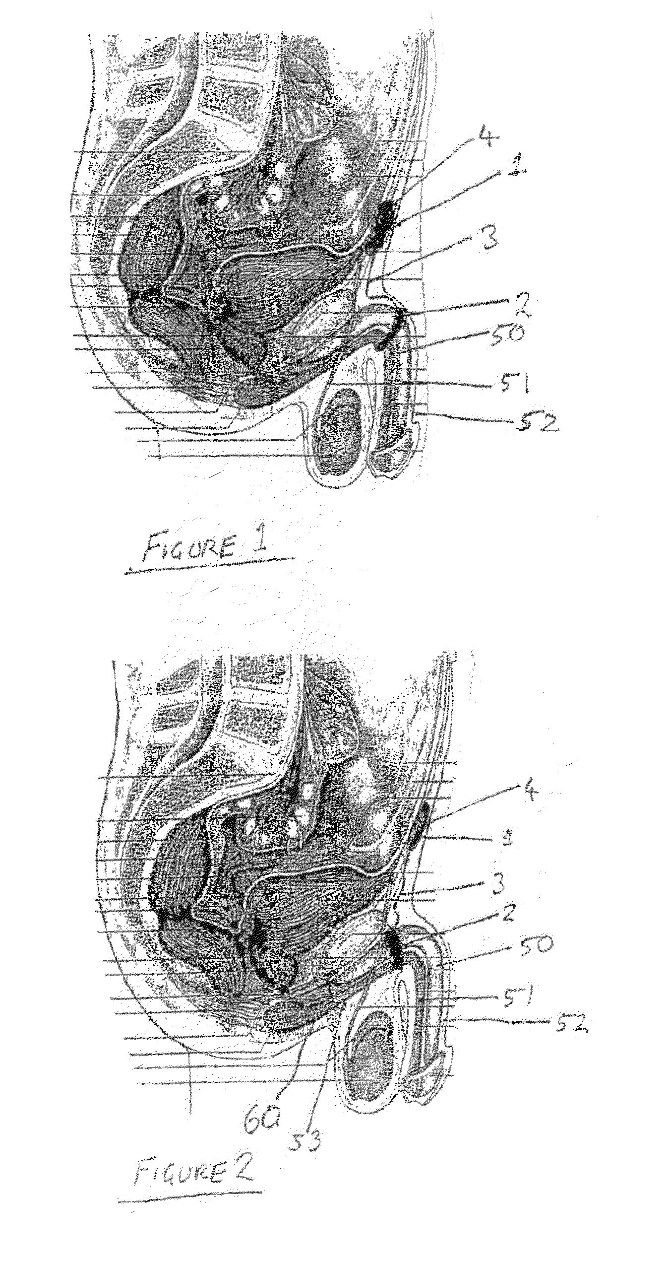 Method and Apparatus for Managing Erectile Dysfunction