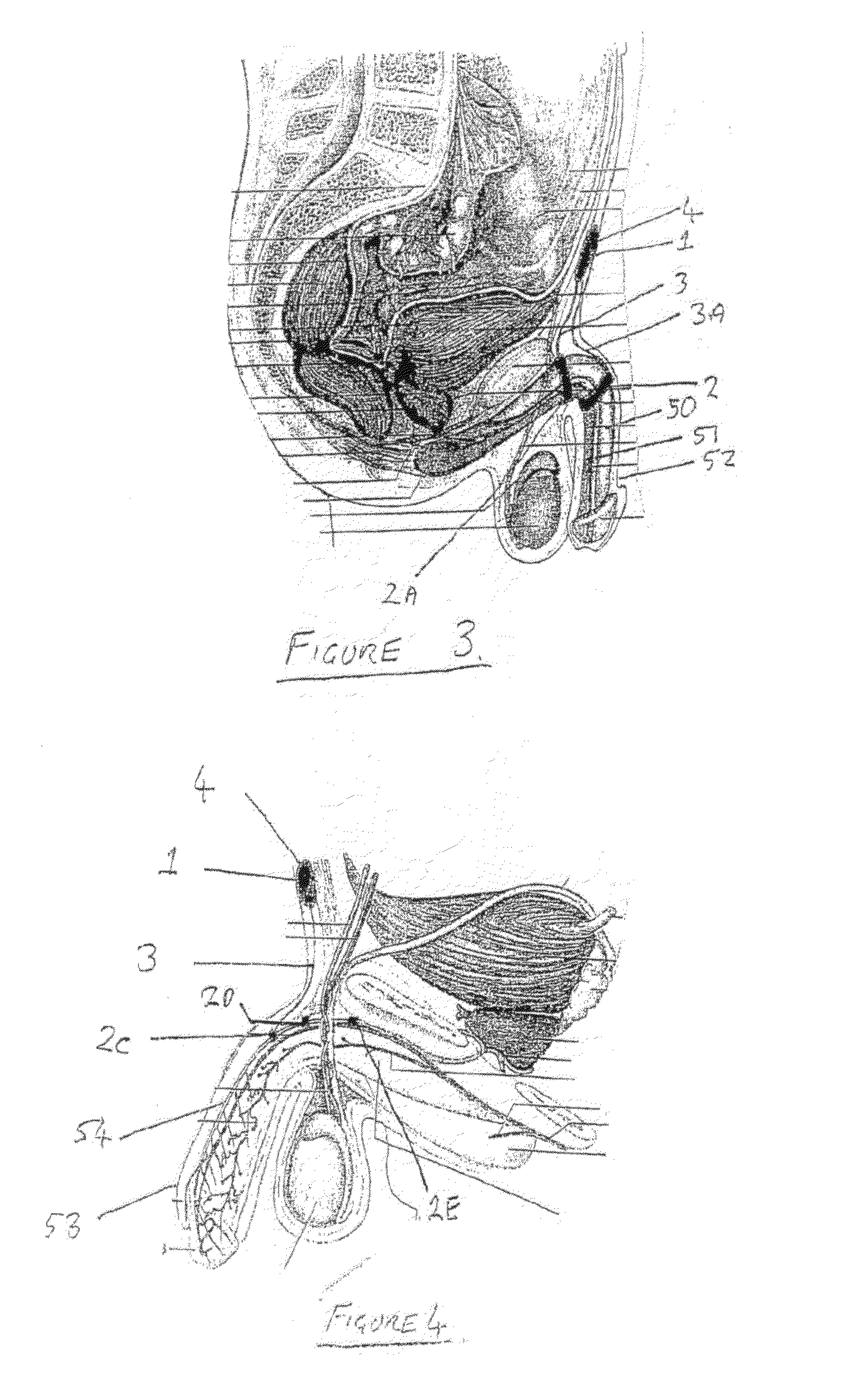 Method and Apparatus for Managing Erectile Dysfunction