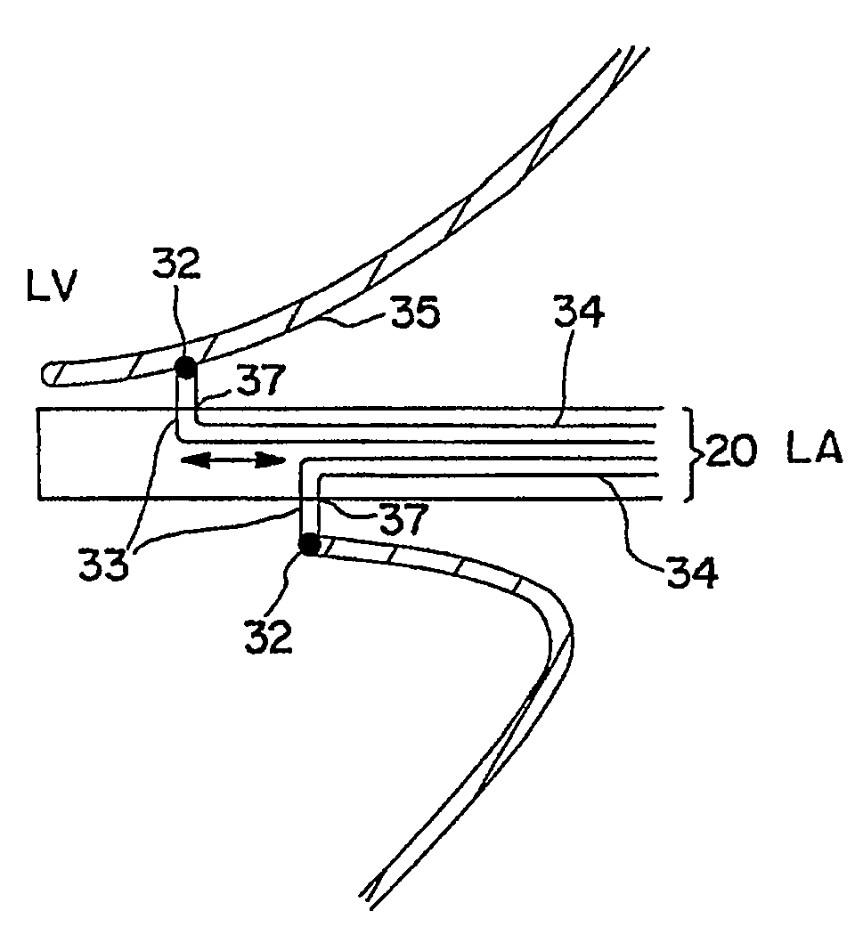 Cardiac devices and methods for percutaneous repair of atrioventricular valves