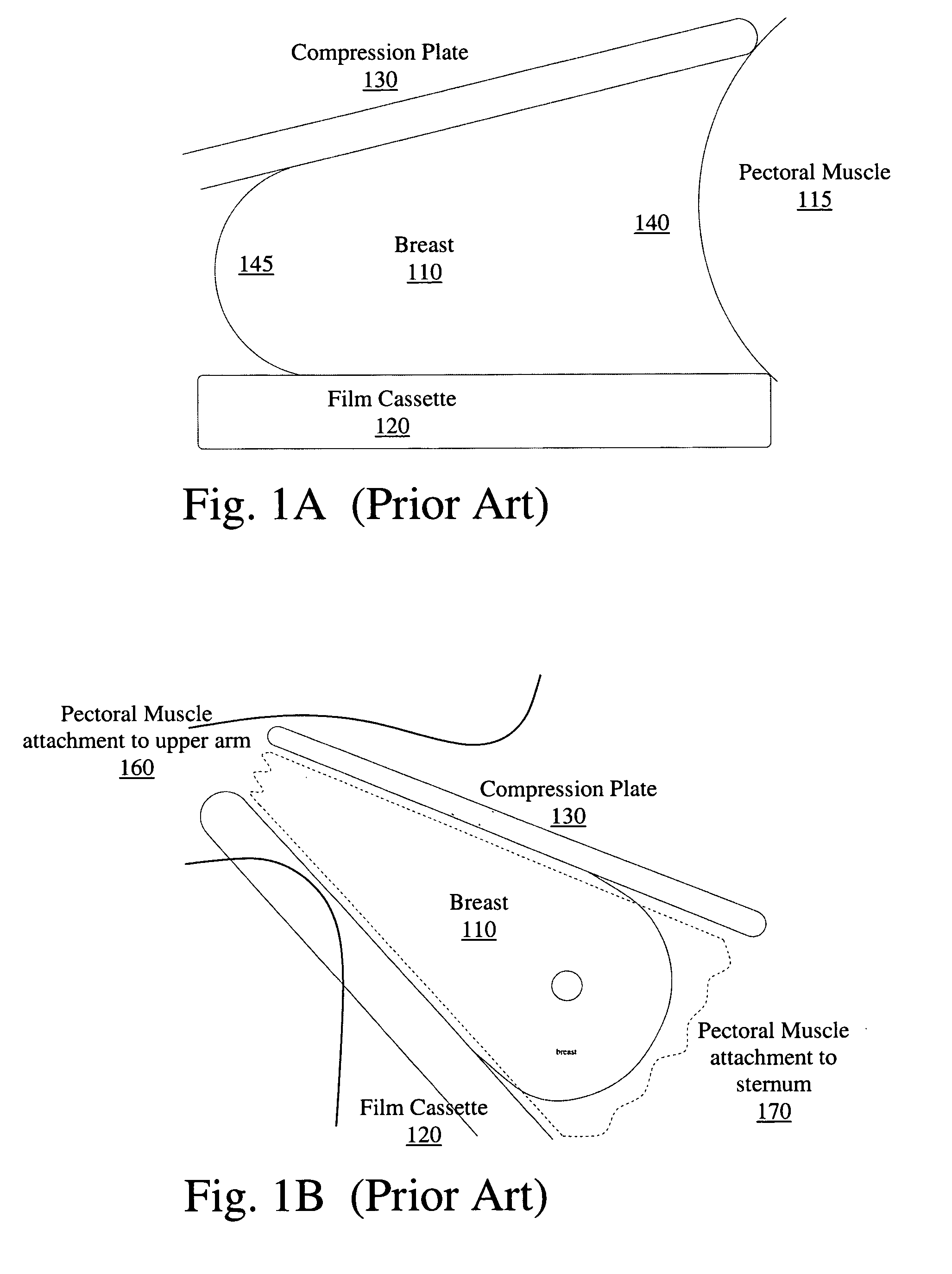 Method and apparatus for correction of mammograms for non-uniform breast thickness