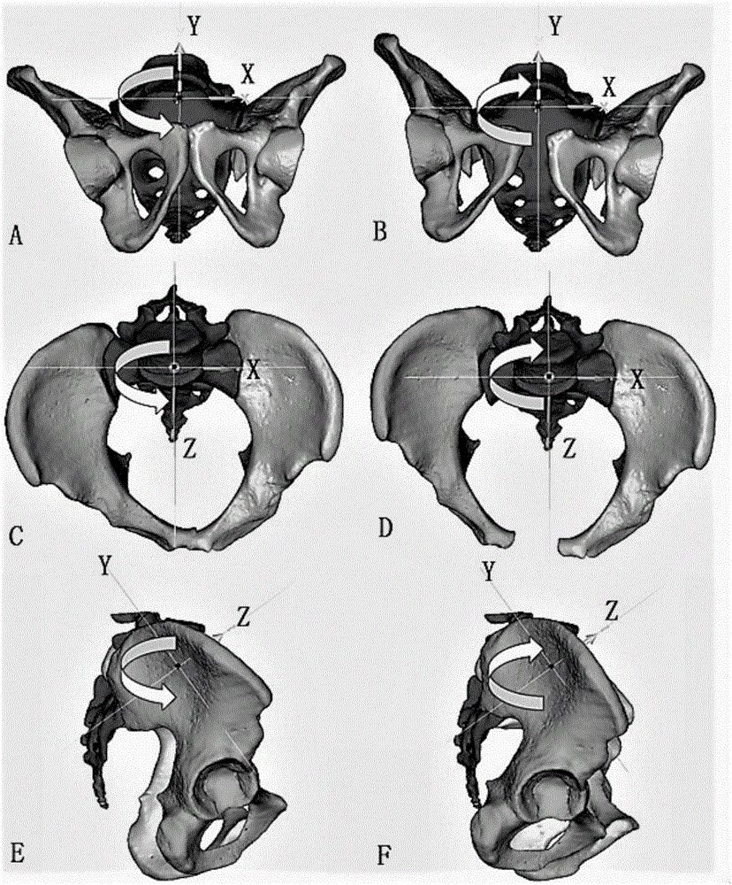 Pelvis displacement measuring method based on pelvis plain film