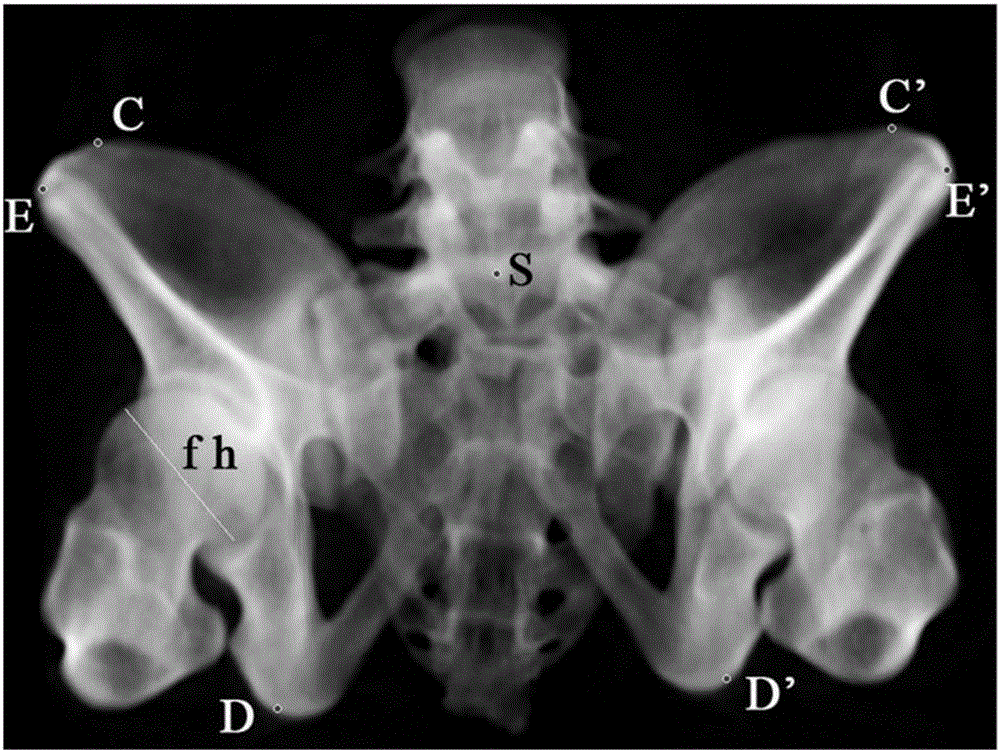 Pelvis displacement measuring method based on pelvis plain film