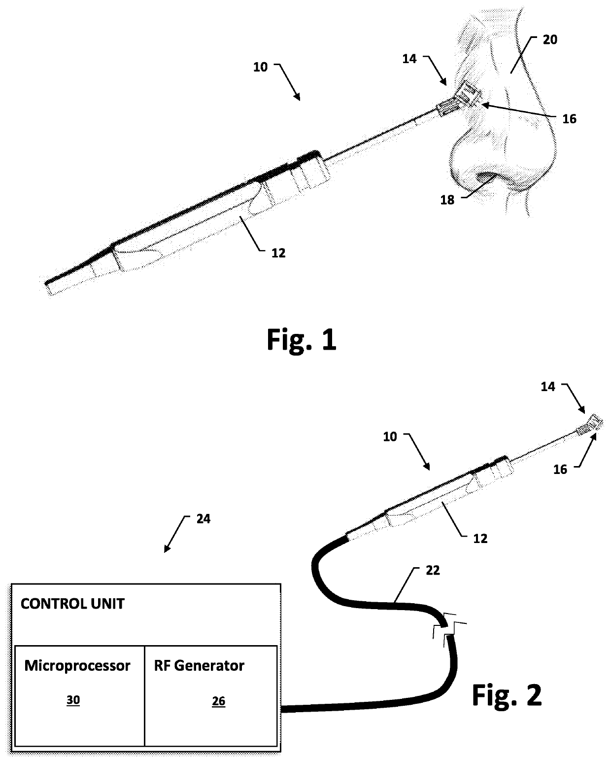 Nasal tissue treatment method and related device