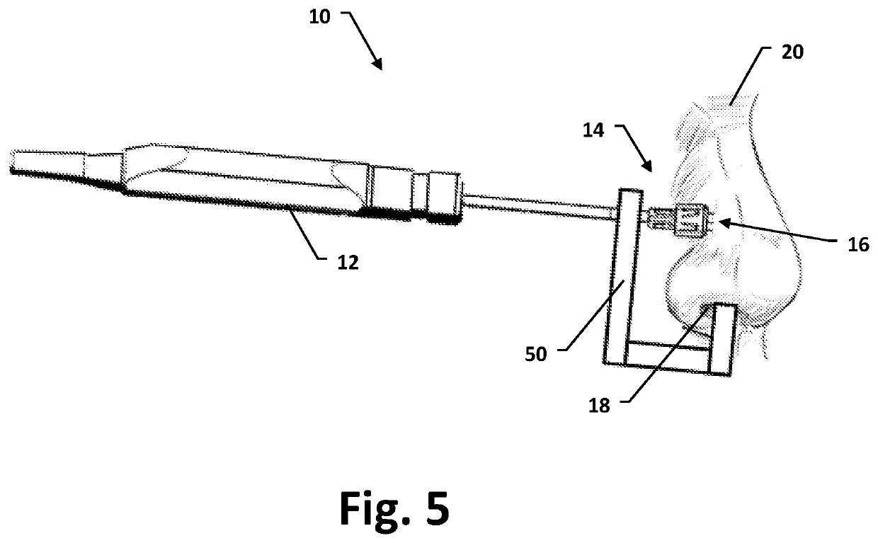 Nasal tissue treatment method and related device