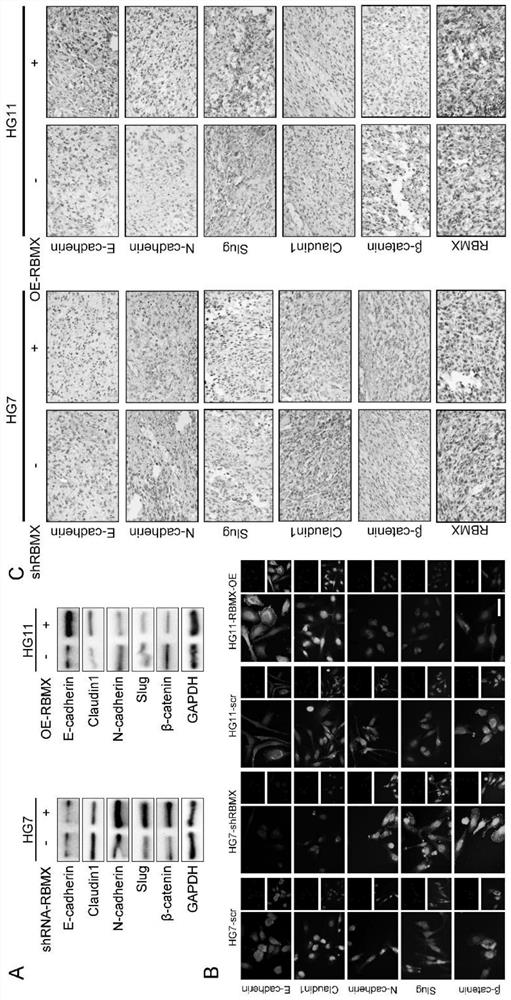 Application of FAM13A gene transcripts in evaluating clinical prognosis of glioblastoma patients