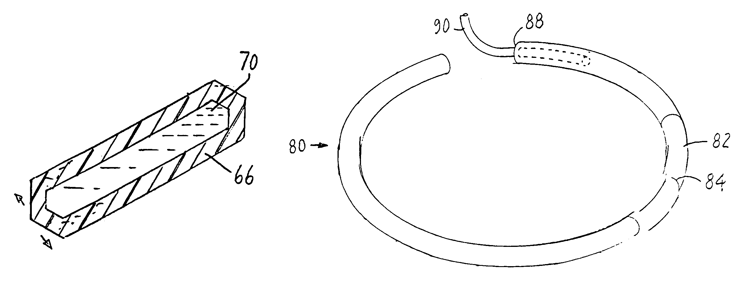 Hybrid intrastromal corneal ring