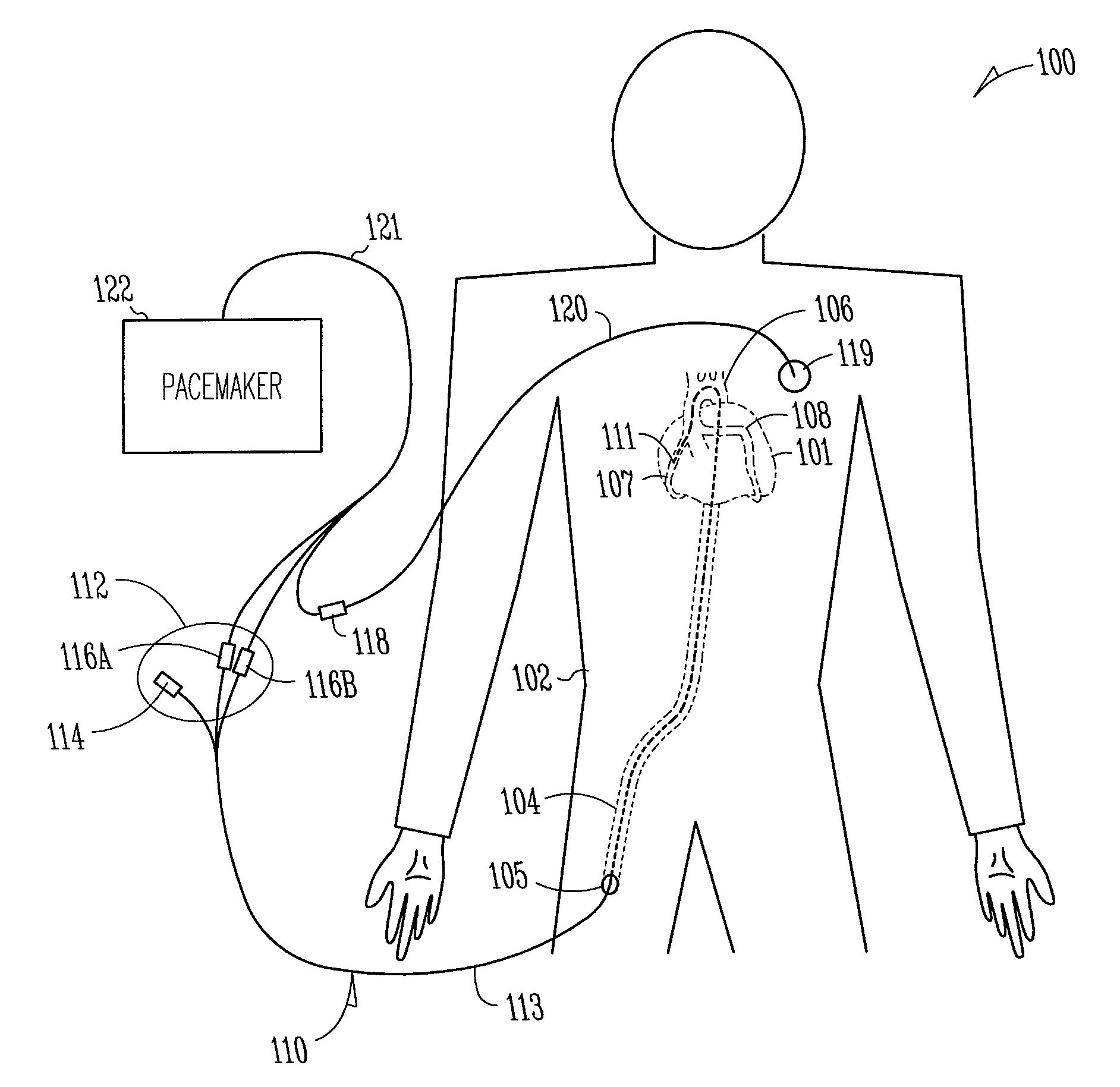 External pacemaker with automatic cardioprotective pacing protocol