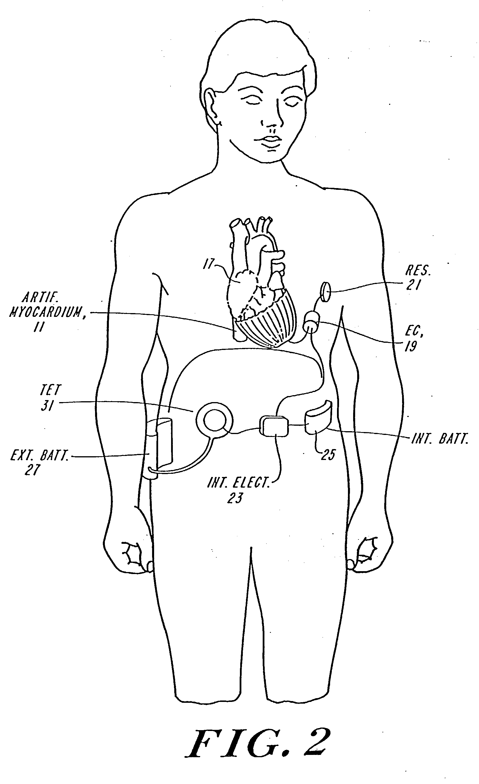 Passive cardiac assistance device